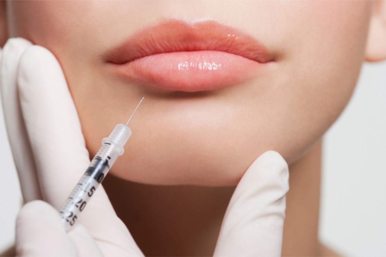 Aumento de labios en la Clínica Dr. Zito