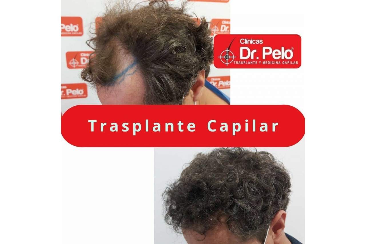 Aumento de popularidad del transplante capilar en los últimos años en España gracias a la mejora de los precios y las técnicas aplicadas