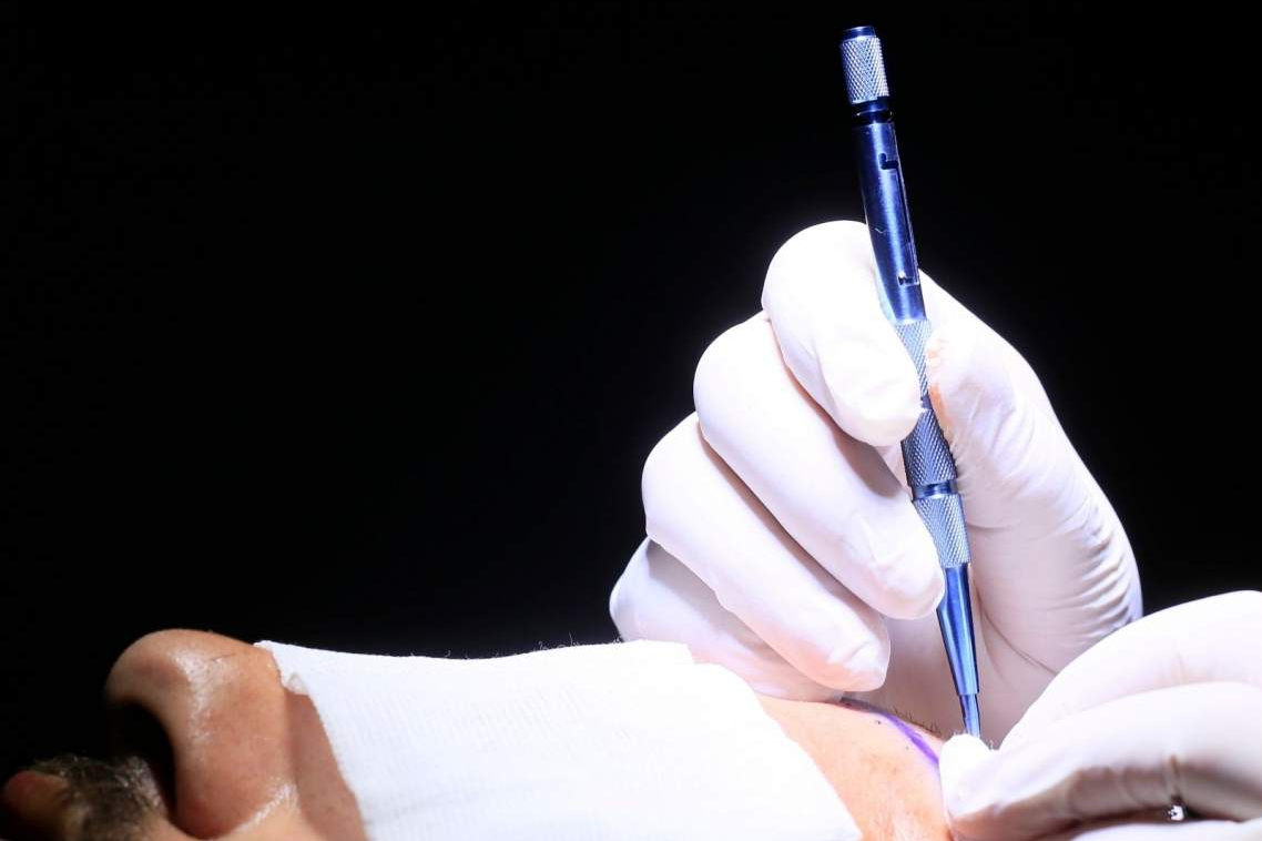 Las técnicas de trasplante capilar de la mano del doctor Bruno Jacobovski