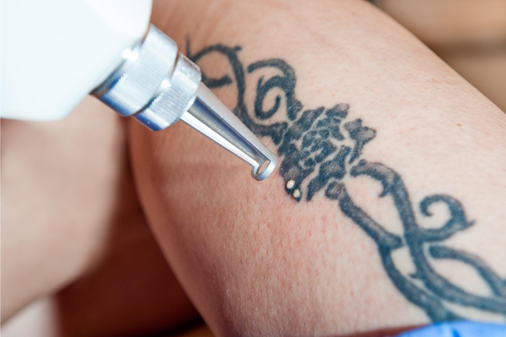 El centro Bodyslim dispone de Yag Láser para eliminar tatuajes