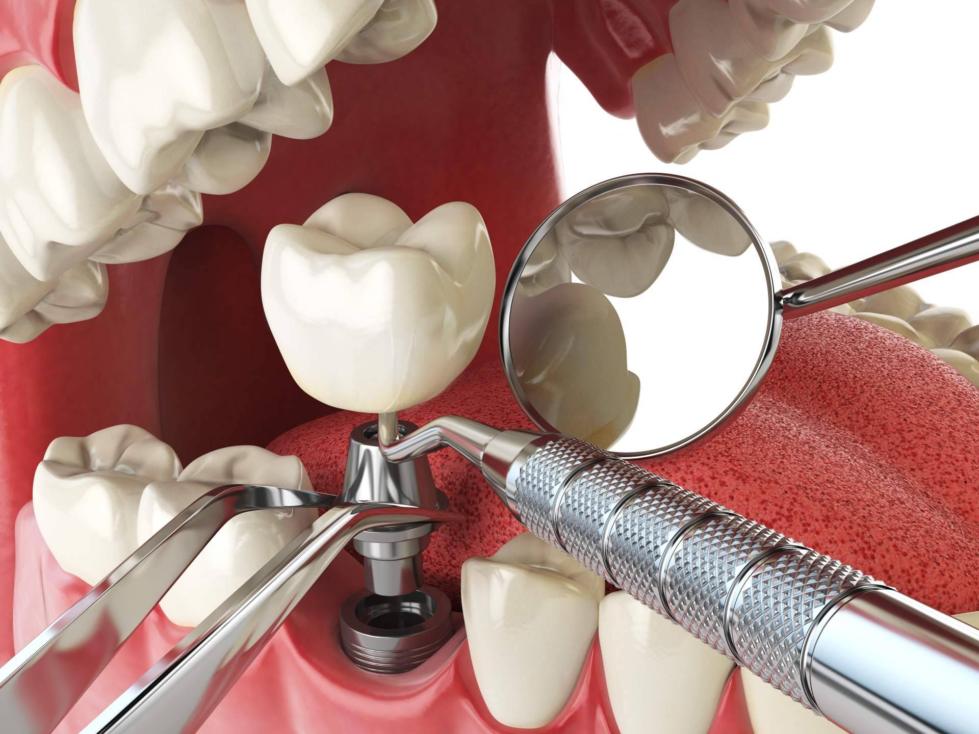 Clínica Artydents en Madrid logra conseguir dientes fijos en un solo día gracias a los implantes dentales de titanio V