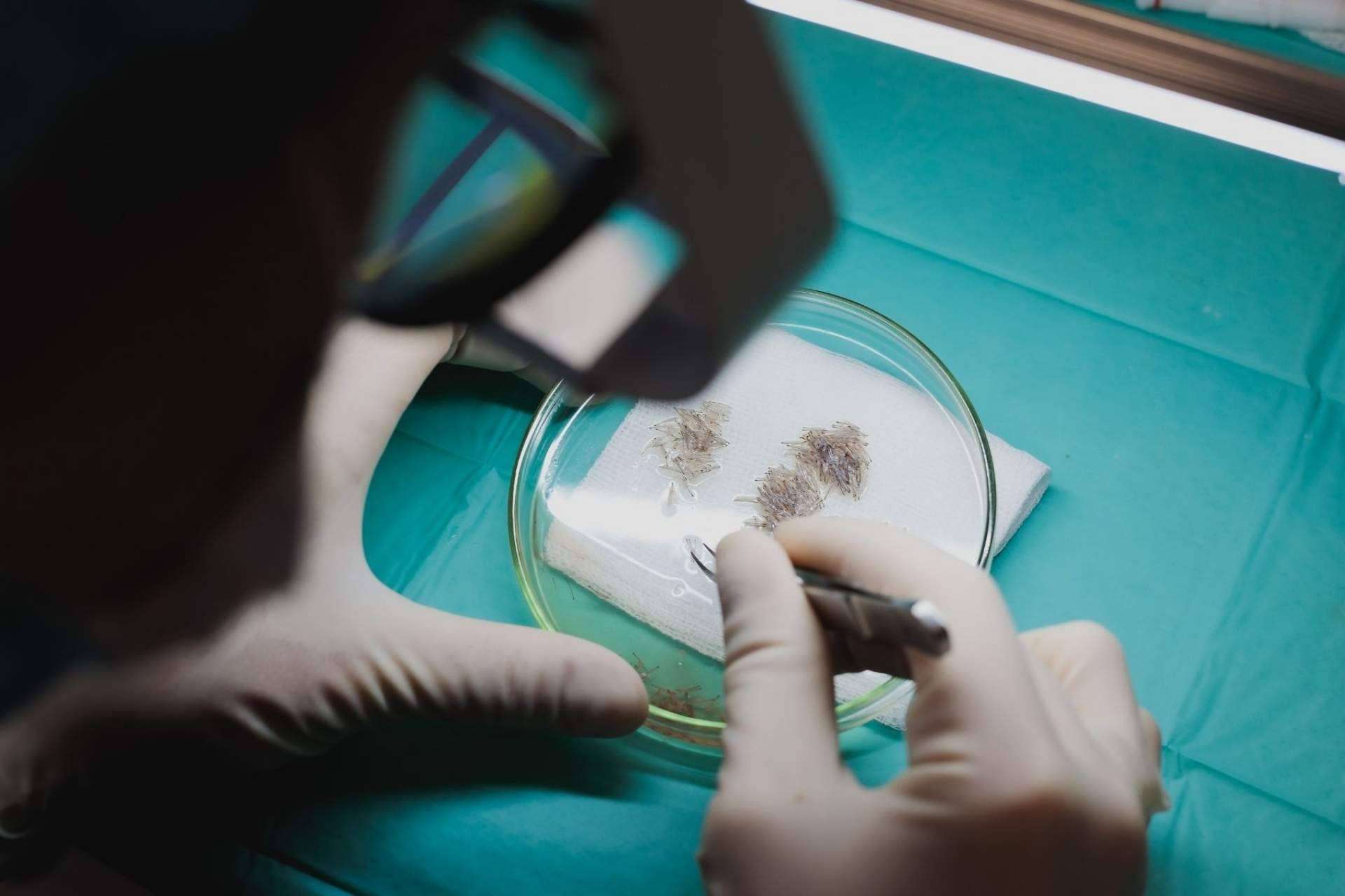 Conseguir un buen trasplante capilar, con Adcure Clinic