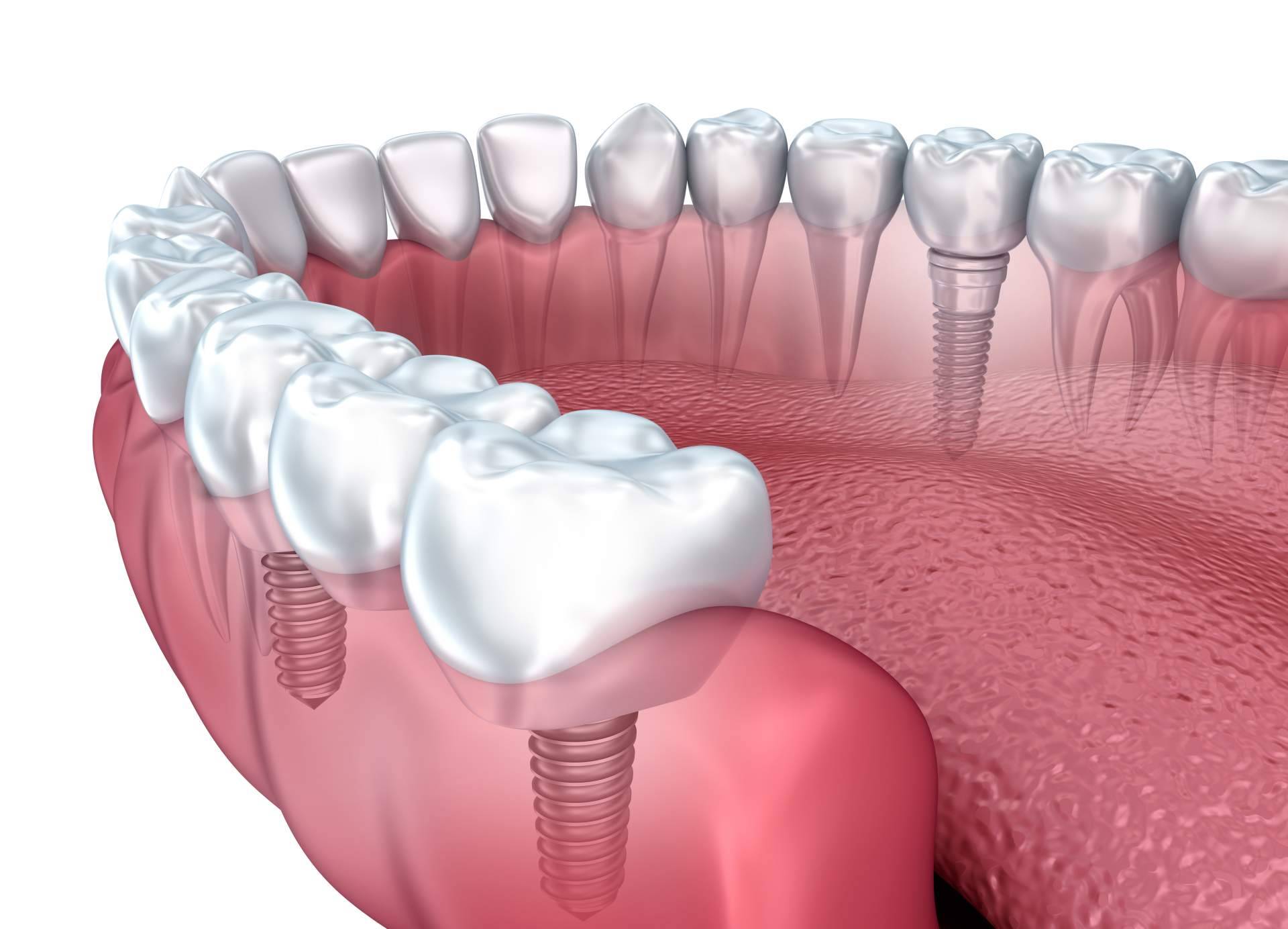 El exclusivo implante dental de titanio en la Clínica de Odontología Artydents de Madrid por solo 199€