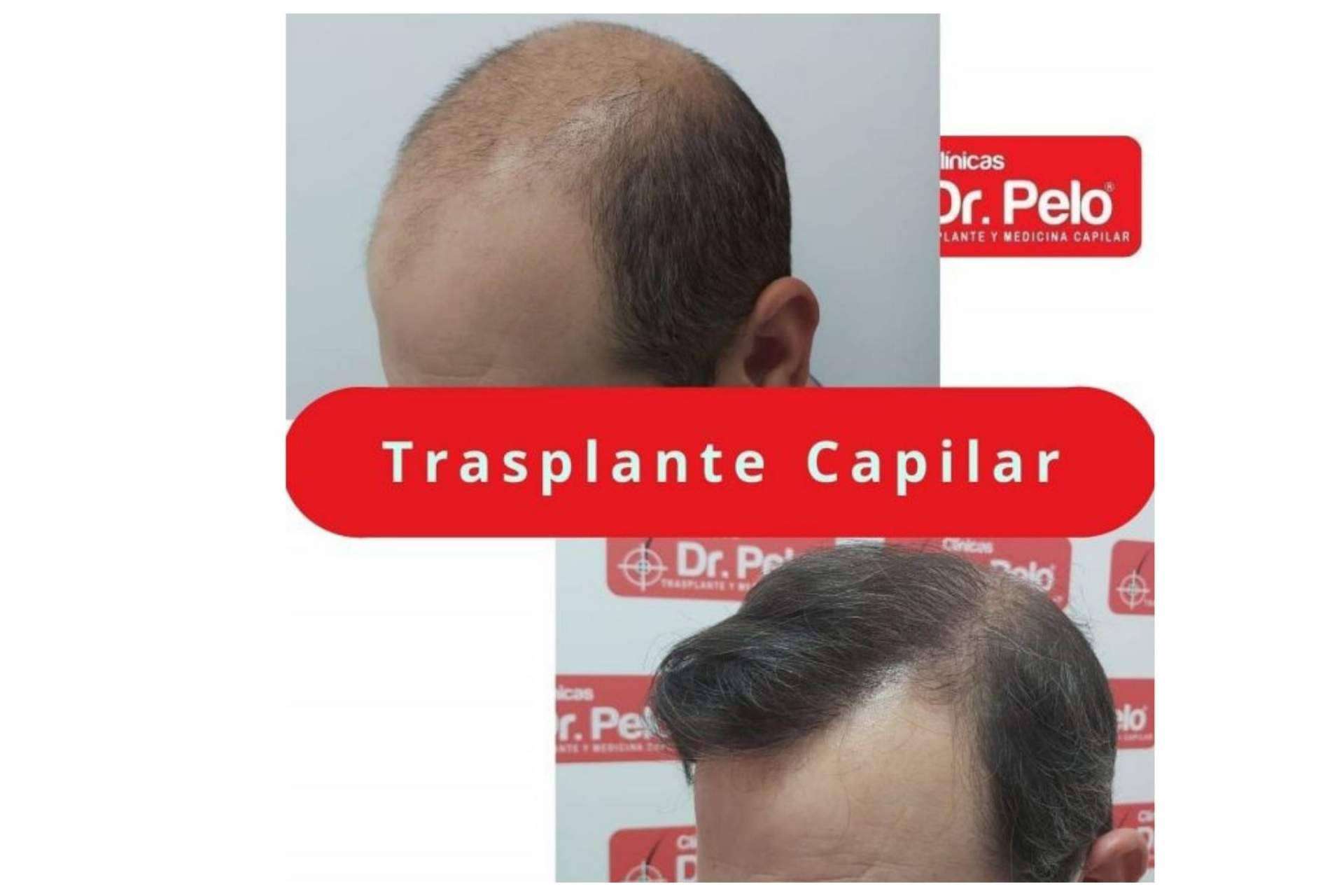 Clínica Dr.Pelo: ¿Cuál es la mejor clínica para realizarse un tratamiento de injerto capilar en Sevilla?