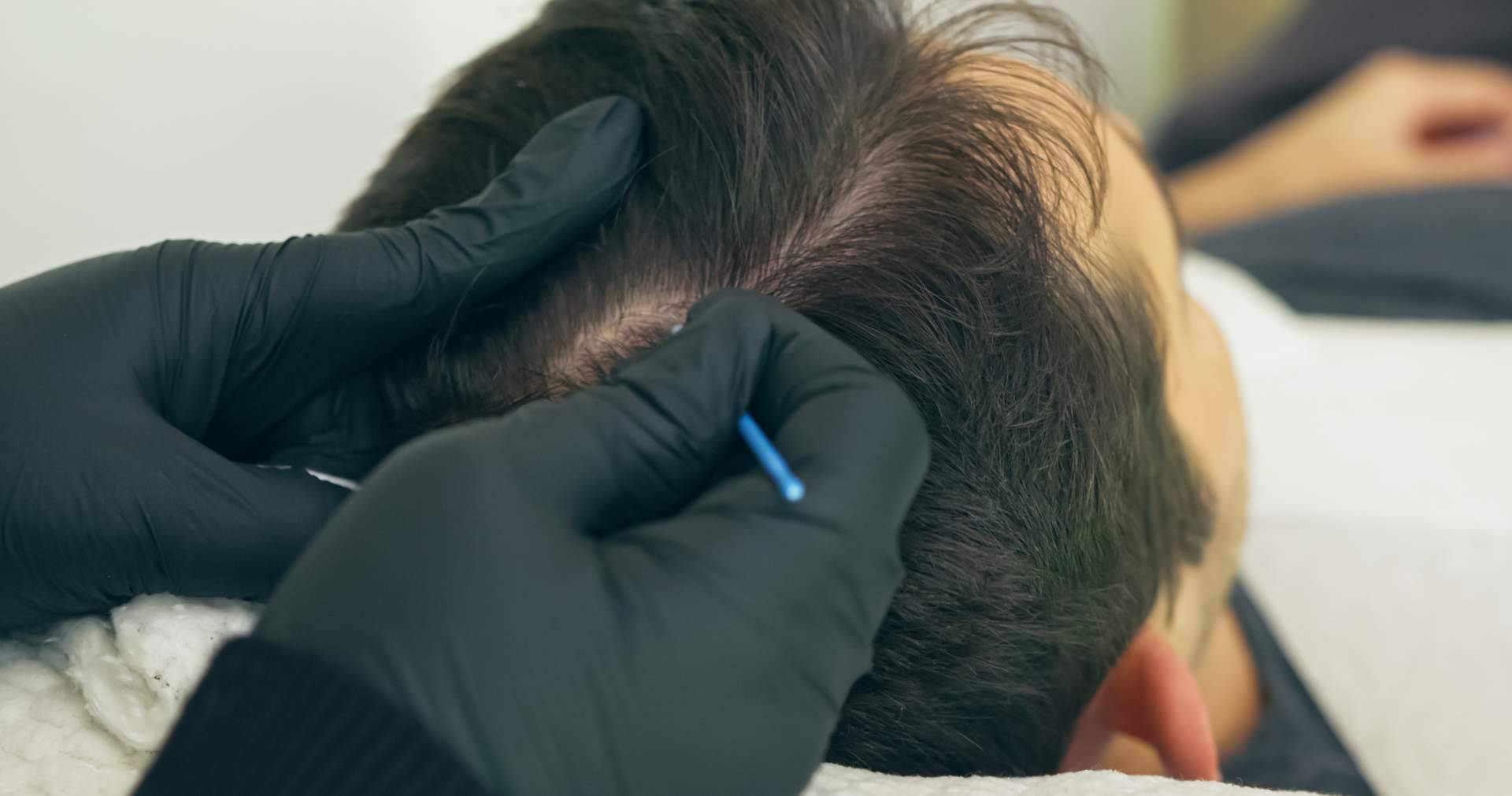Micropigmentación Capilar en Distrito Wellness Concept