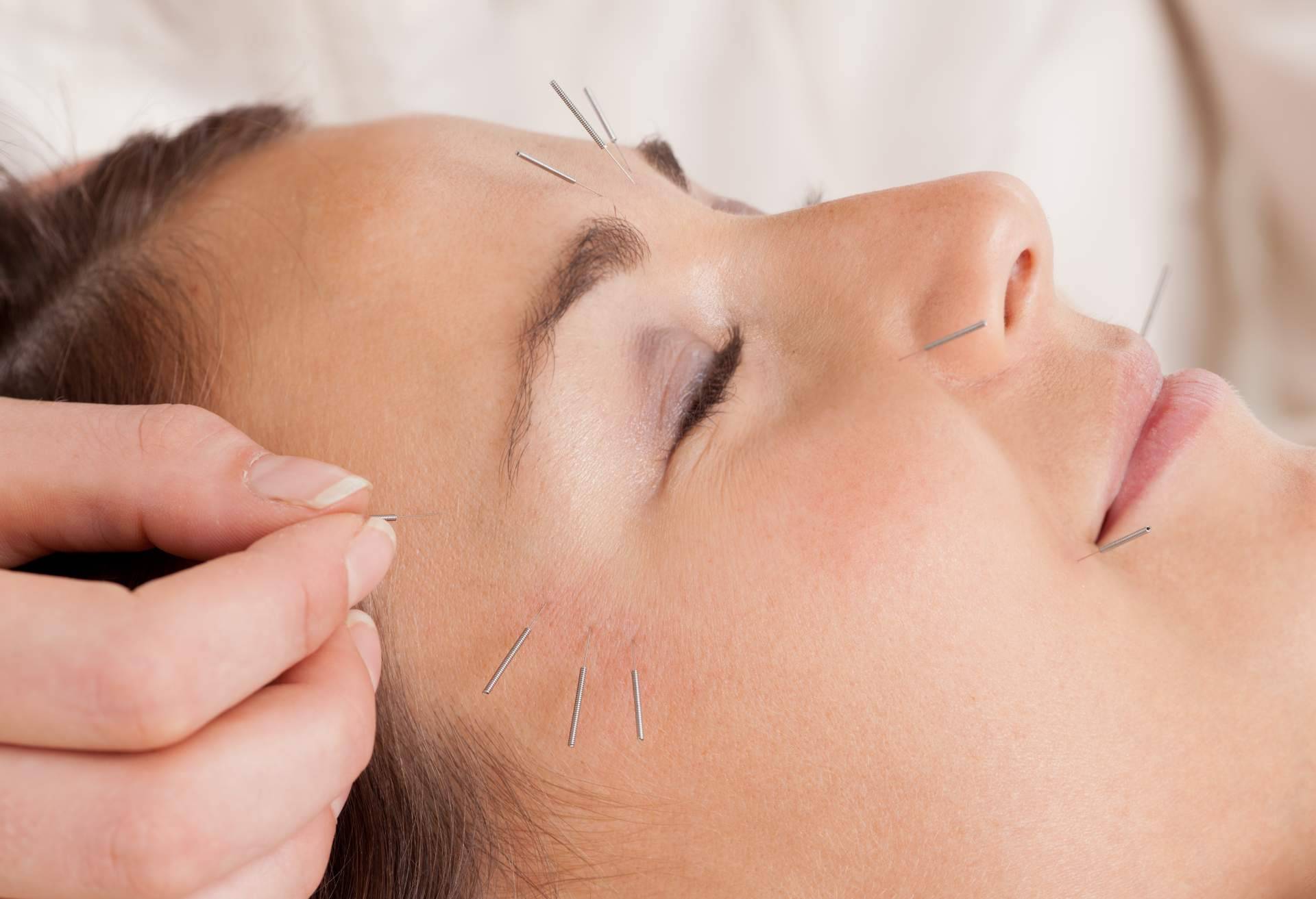 Acupuntura estética a domicilio por el centro Kikai