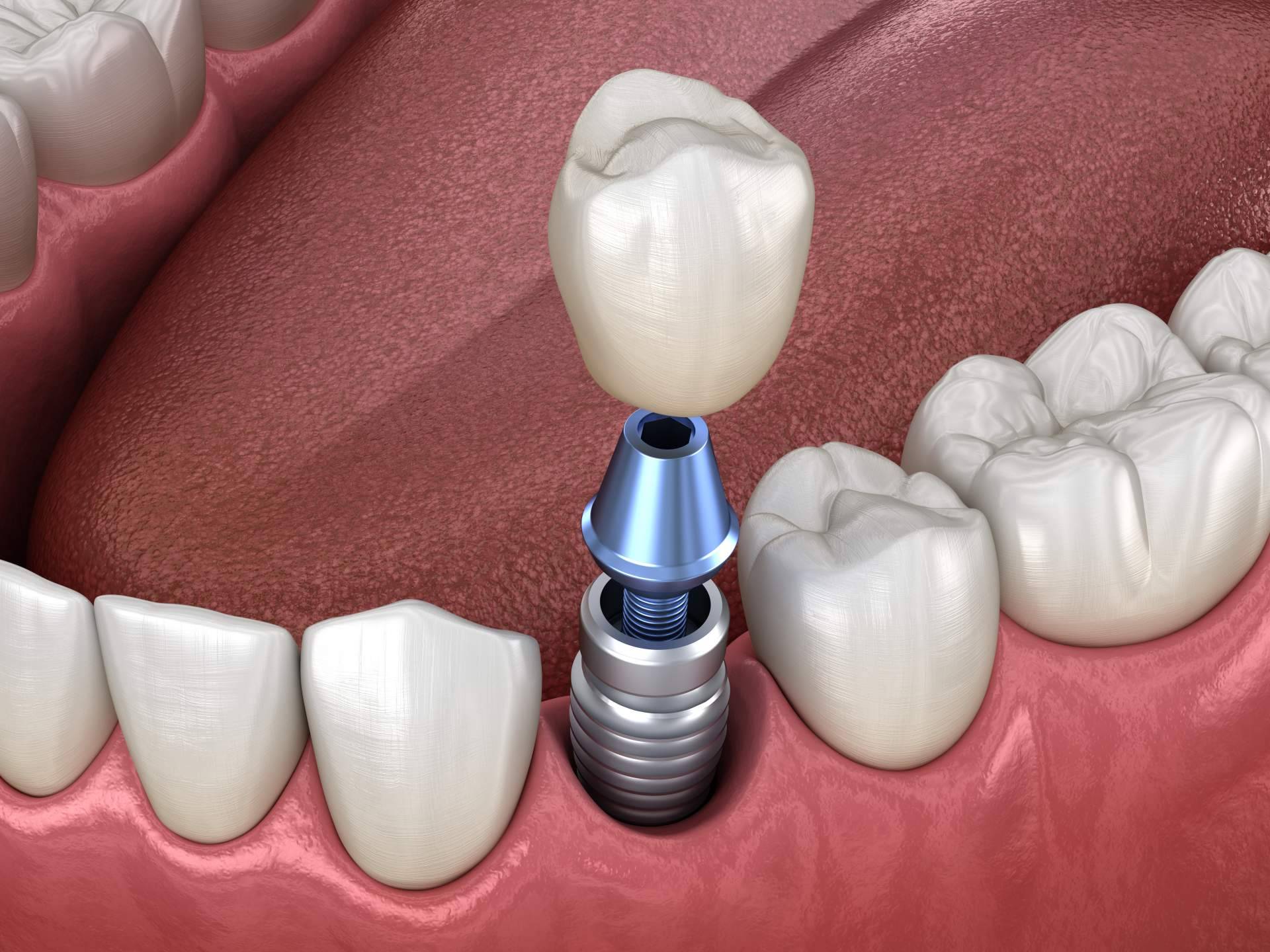 Dientes fijos en un día: la realidad de la mano de la Clínica dental especializada Artydents en Madrid