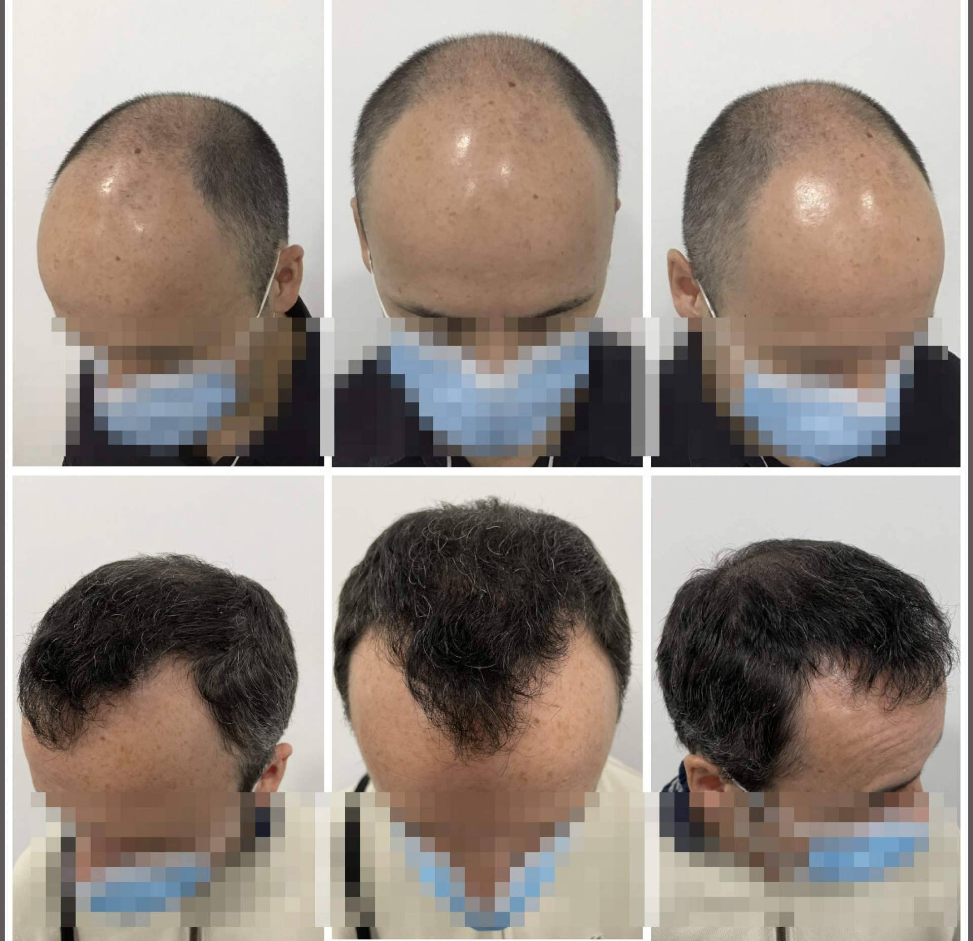 Natural y denso: Así es el injerto capilar ofrecido por el Dr. Bruno Jacobovski en Barcelona