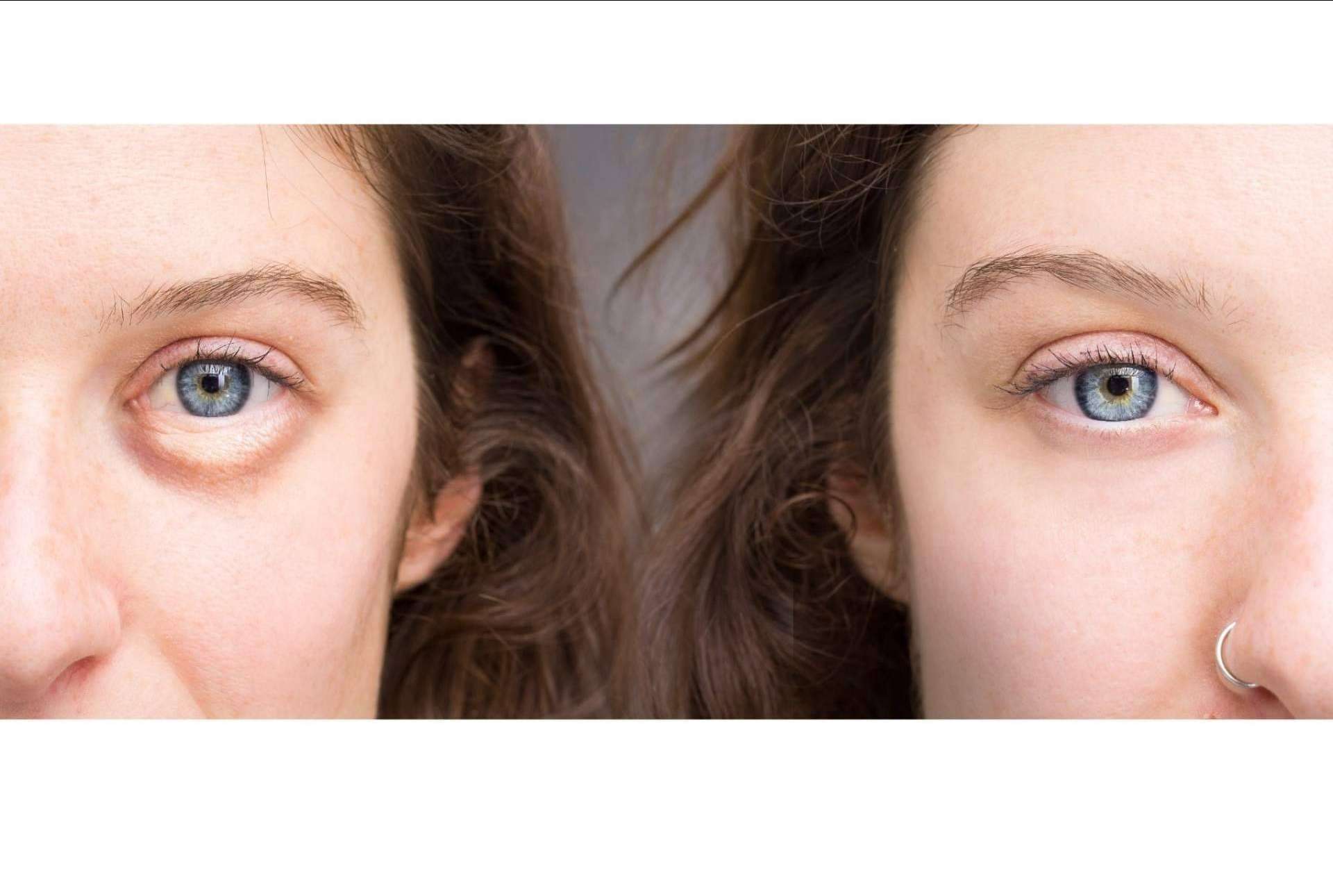 Ácido hialurónico para combatir las ojeras en la Unidad de medicina estética FEMME de Santiago de Compostela con la Dra. Alfonsina Uriburu