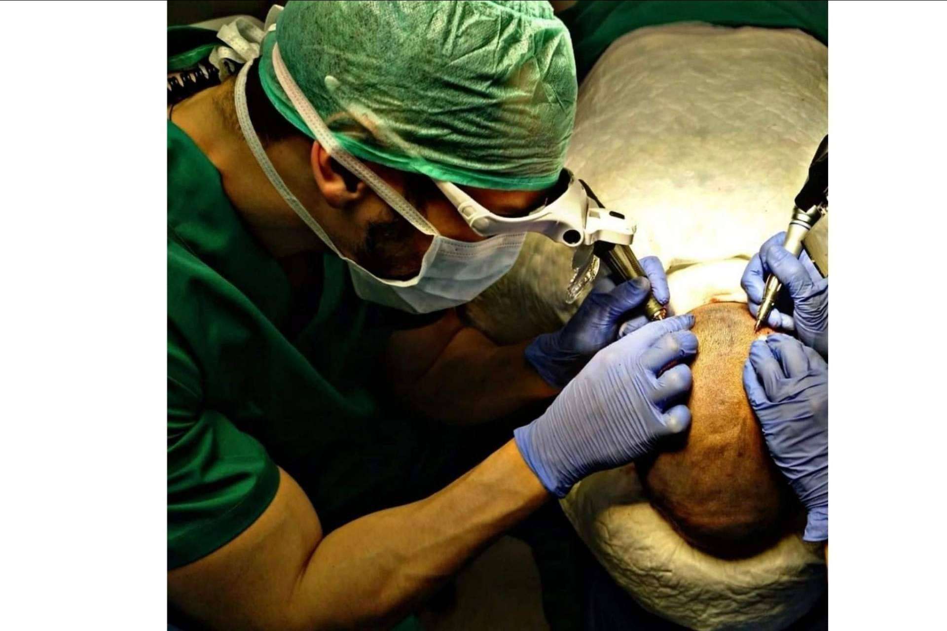 Doctor Bern: ¿A qué edad es recomendable realizarse un injerto capilar?