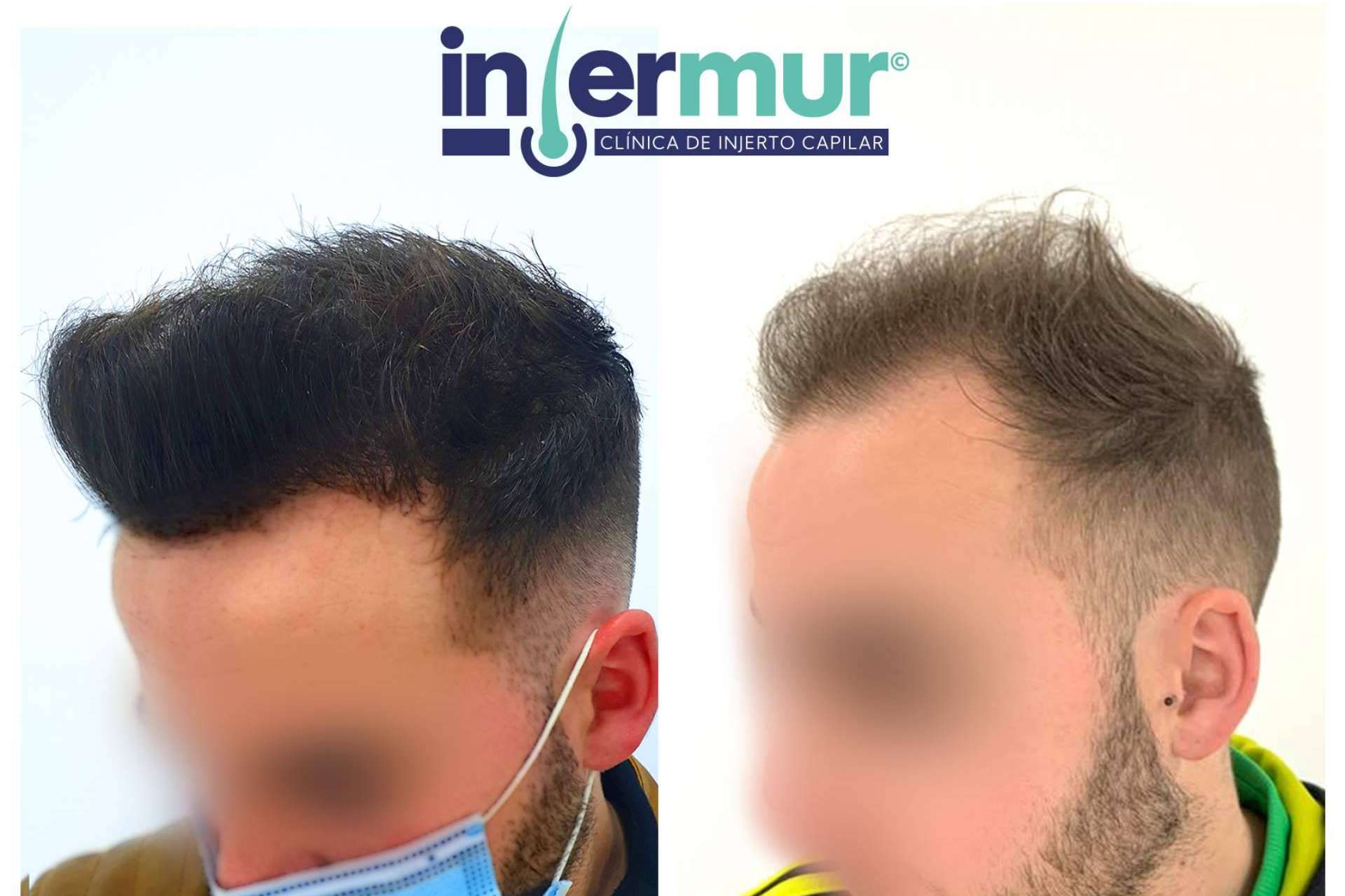 Injermur ofrece una técnica de injerto capilar que permite operaciones sin cicatriz