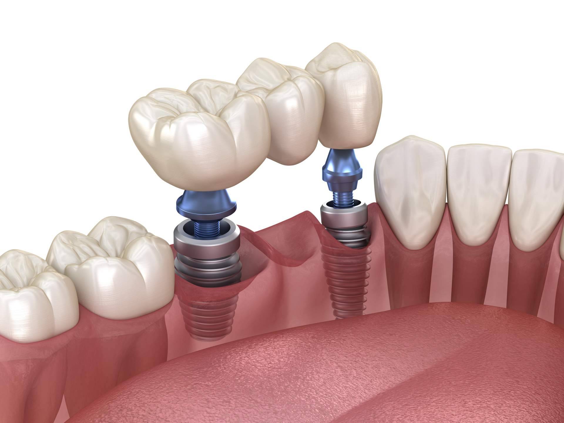 El procedimiento de implante dental de titanio en Sevilla que ofrece Clínica Dental Helident