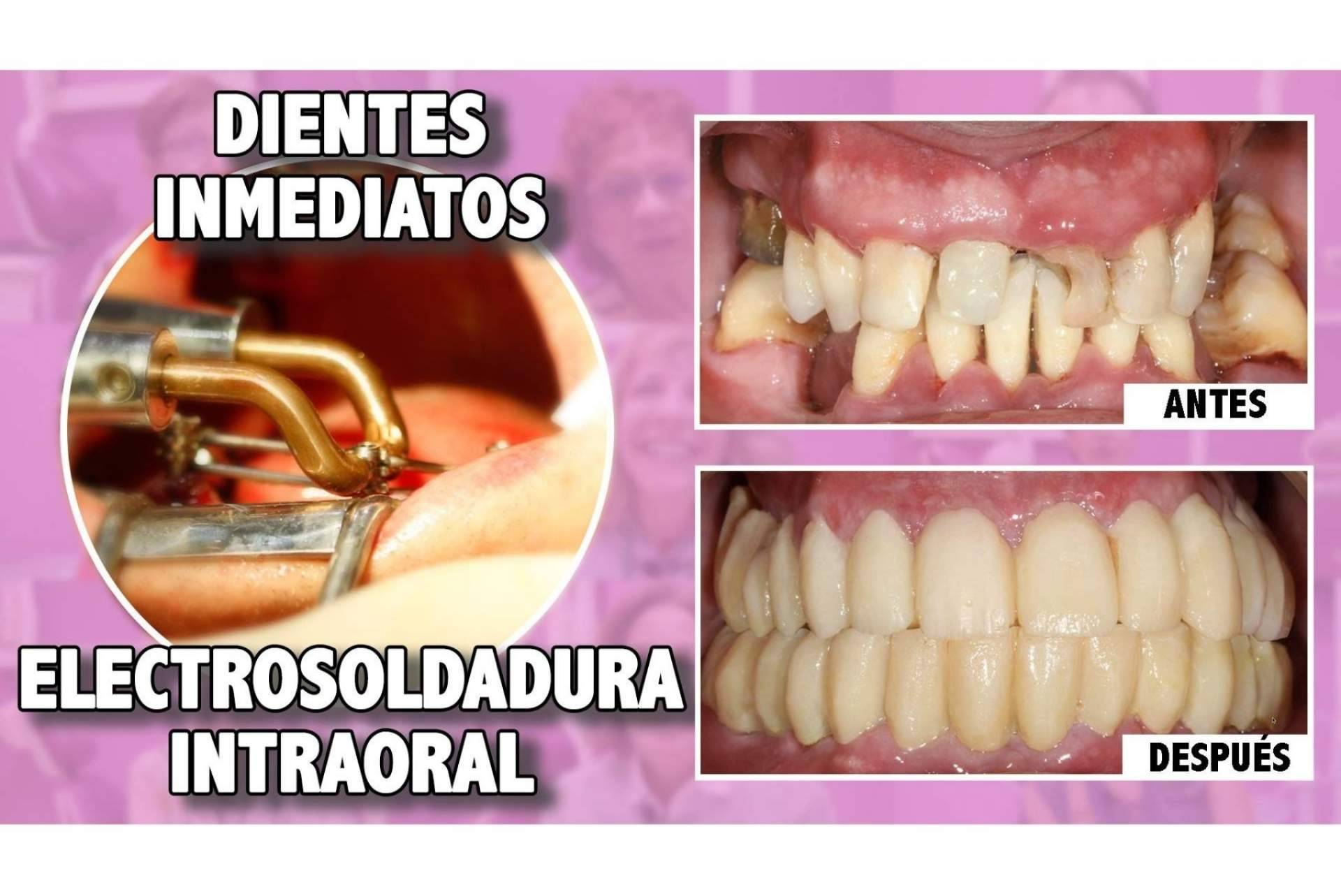 La técnica del Dr. Ismael Soriano que ofrece múltiples ventajas a los pacientes, los implantes con dientes inmediatos