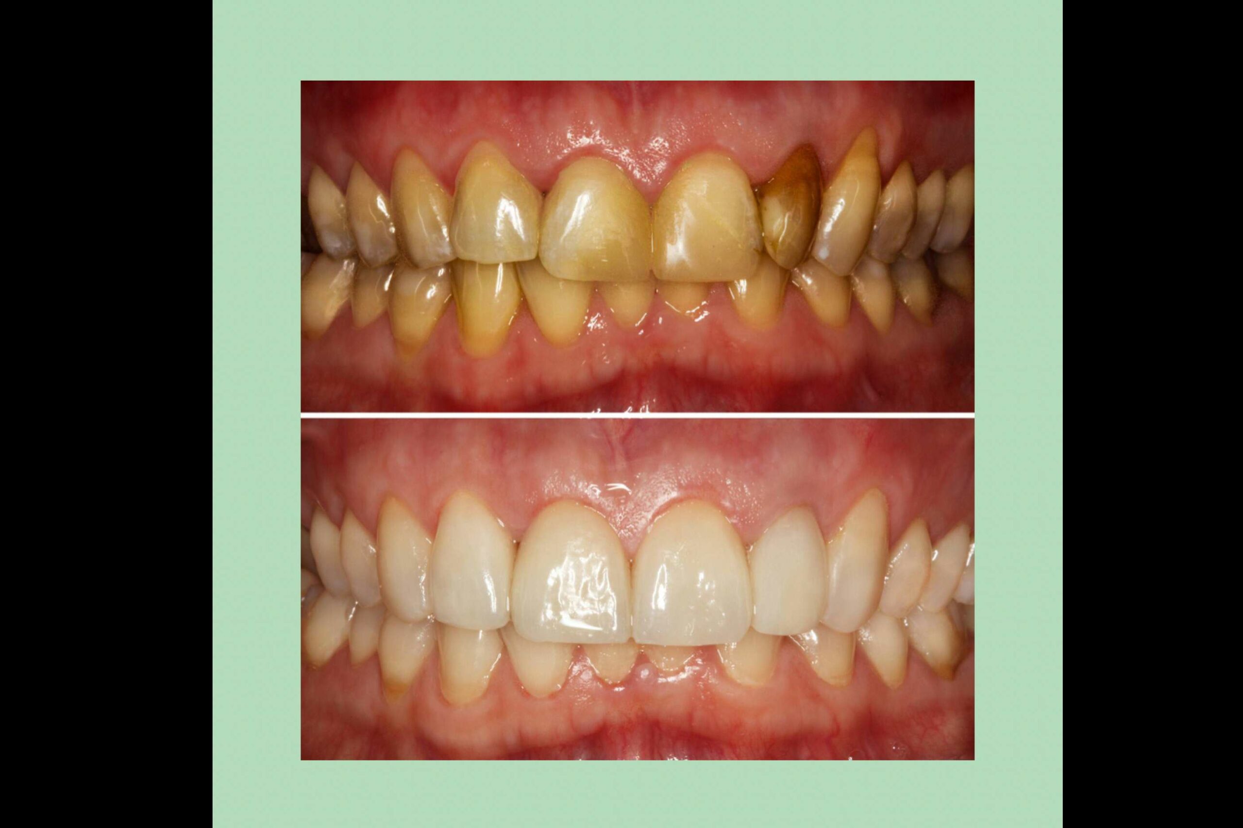 La aplicación de carillas dentales en la Clínica Paula Vidal