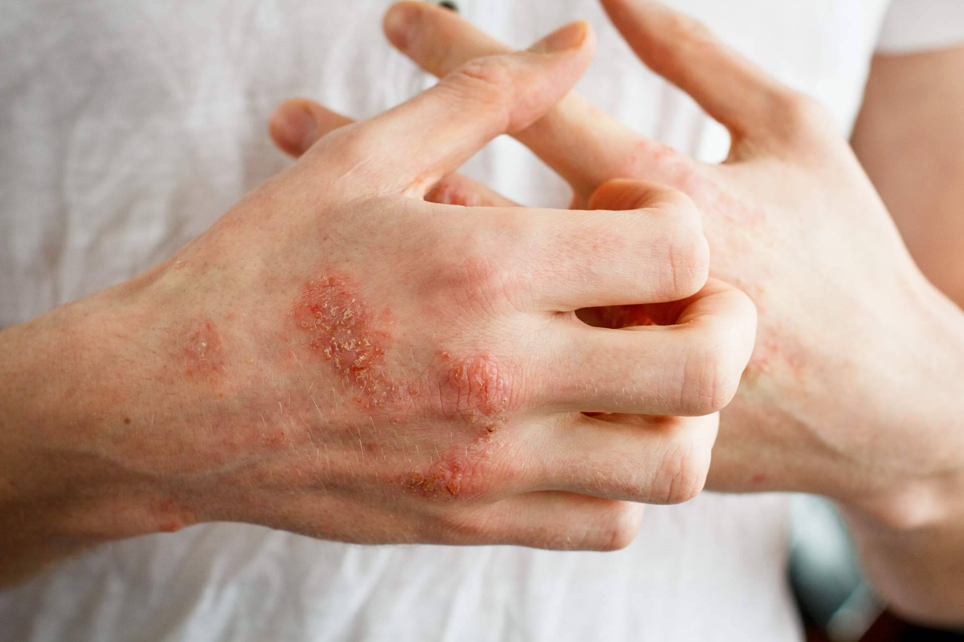 Laboratorio Géomer expone las diferencias entre un eczema atópico y un eczema de contacto