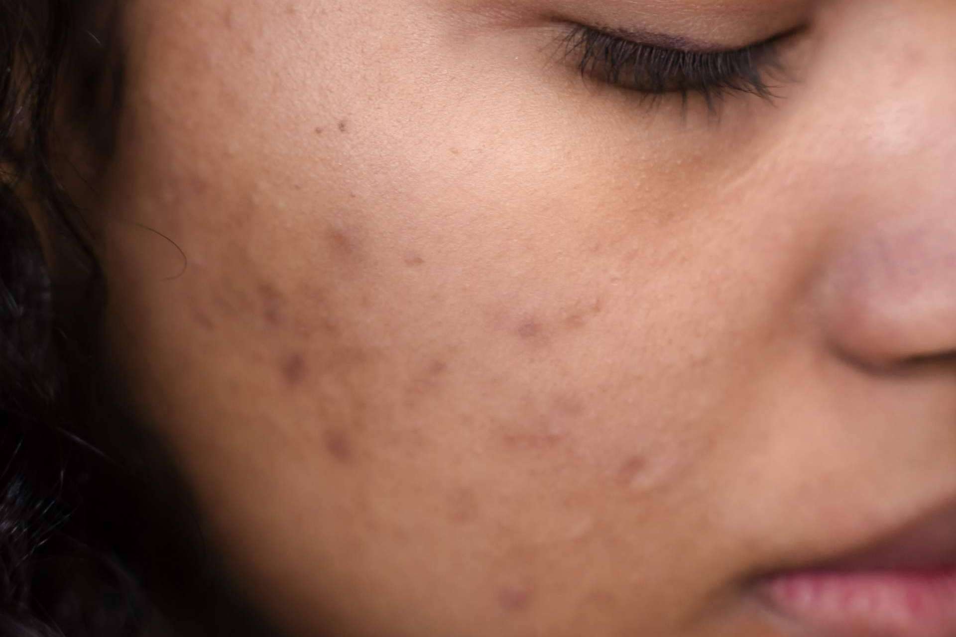 Los beneficios del tratamiento contra el acné de Bėyo Beauty