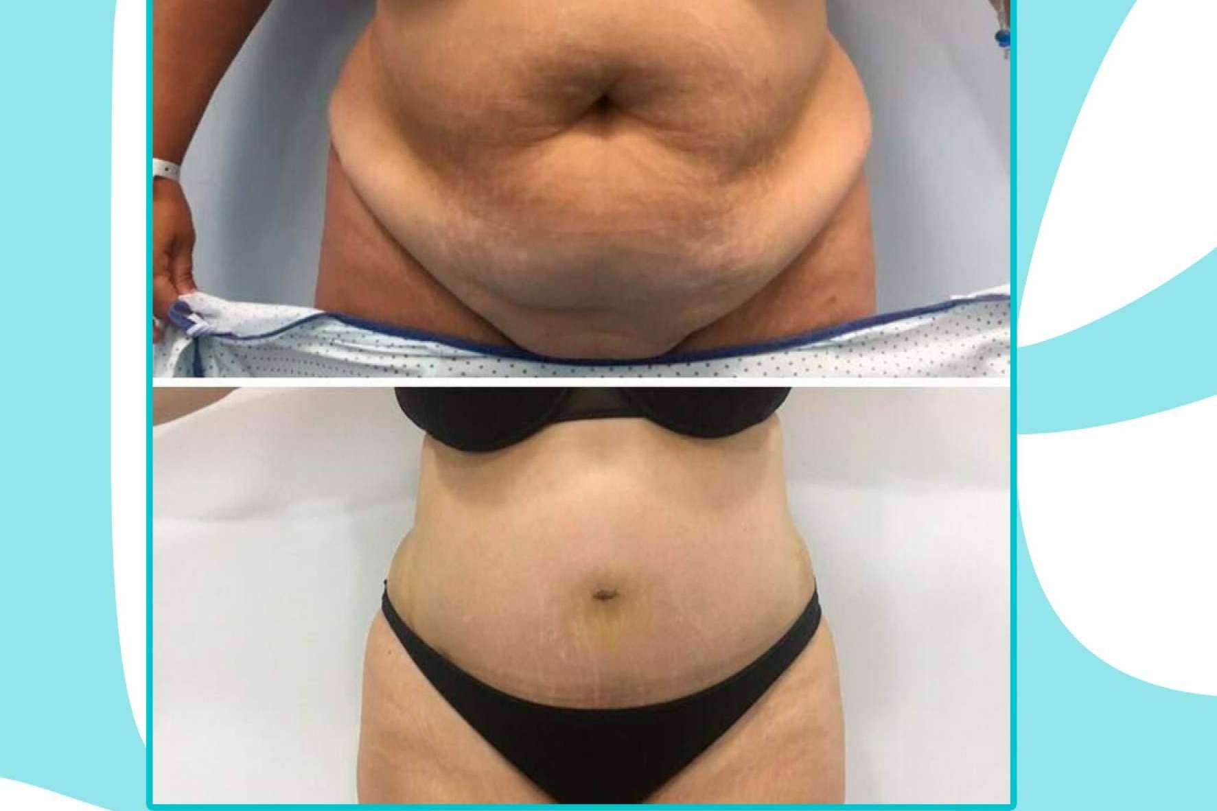 Lucir el cuerpo soñado gracias a los tratamientos de cirugía estética corporal de Clínicas Be