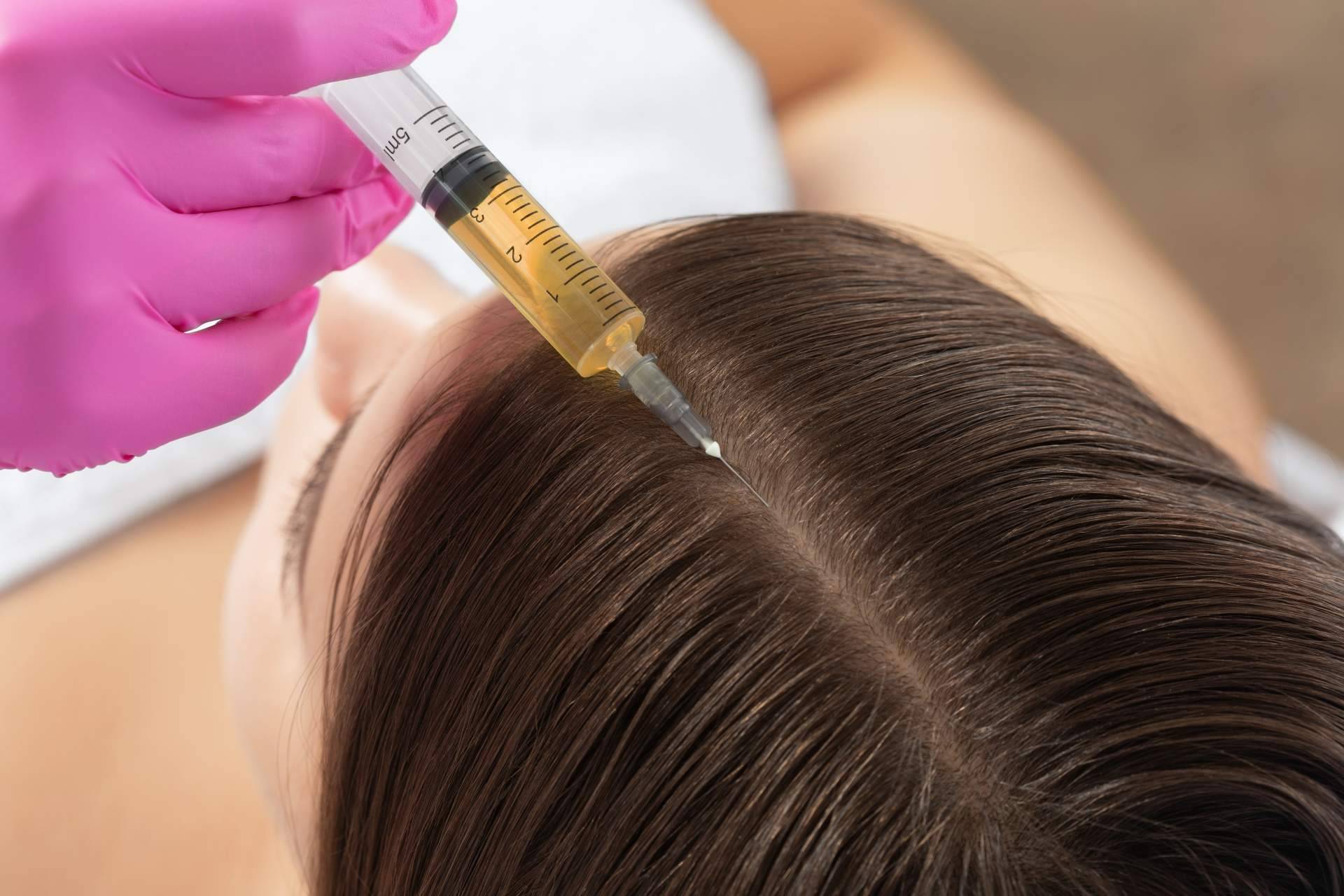 Mesoterapia capilar, vitaminas y plasma rico en plaquetas