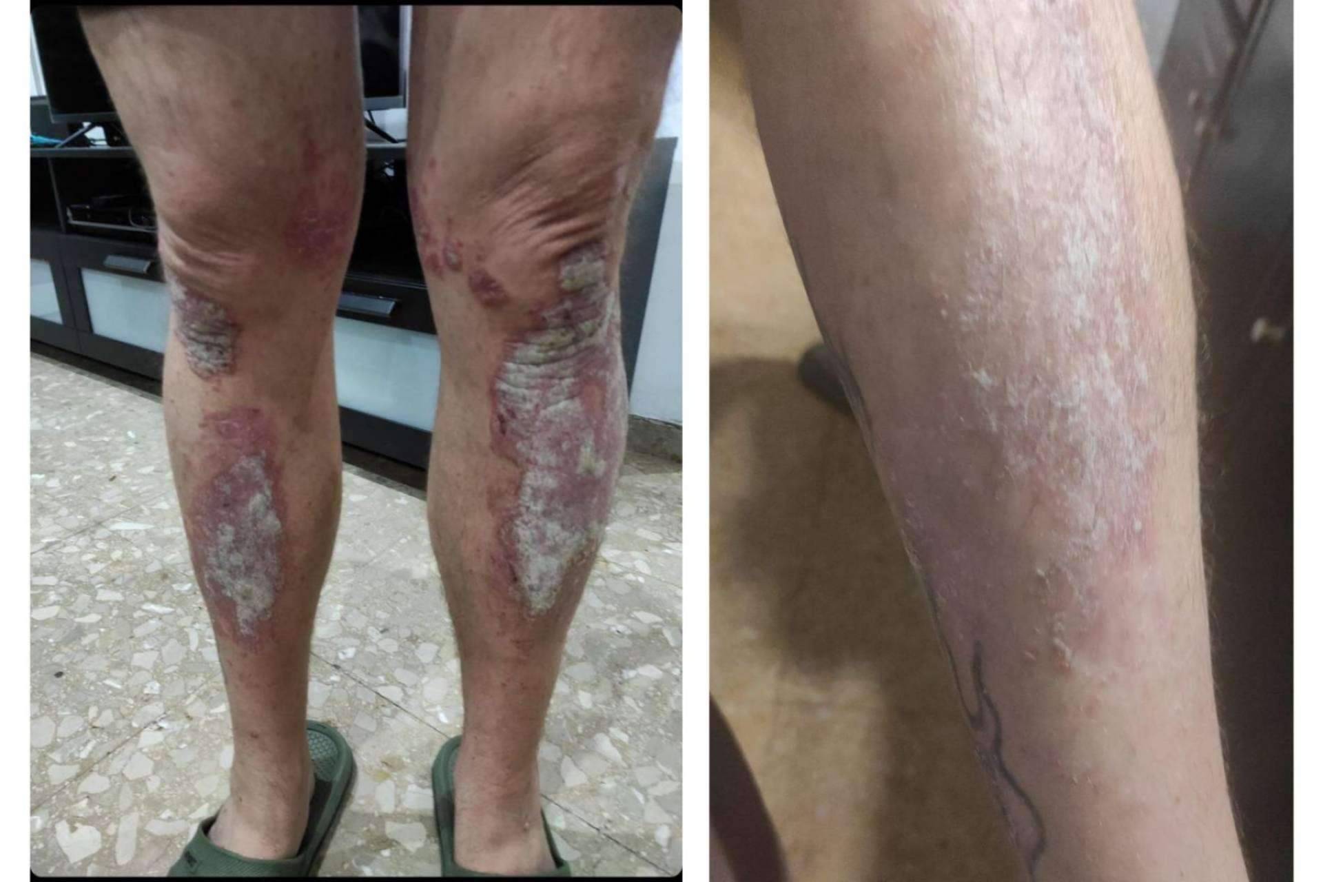 El antes y después de utilizar la crema hidratante de Green Cornerss en pieles atópicas