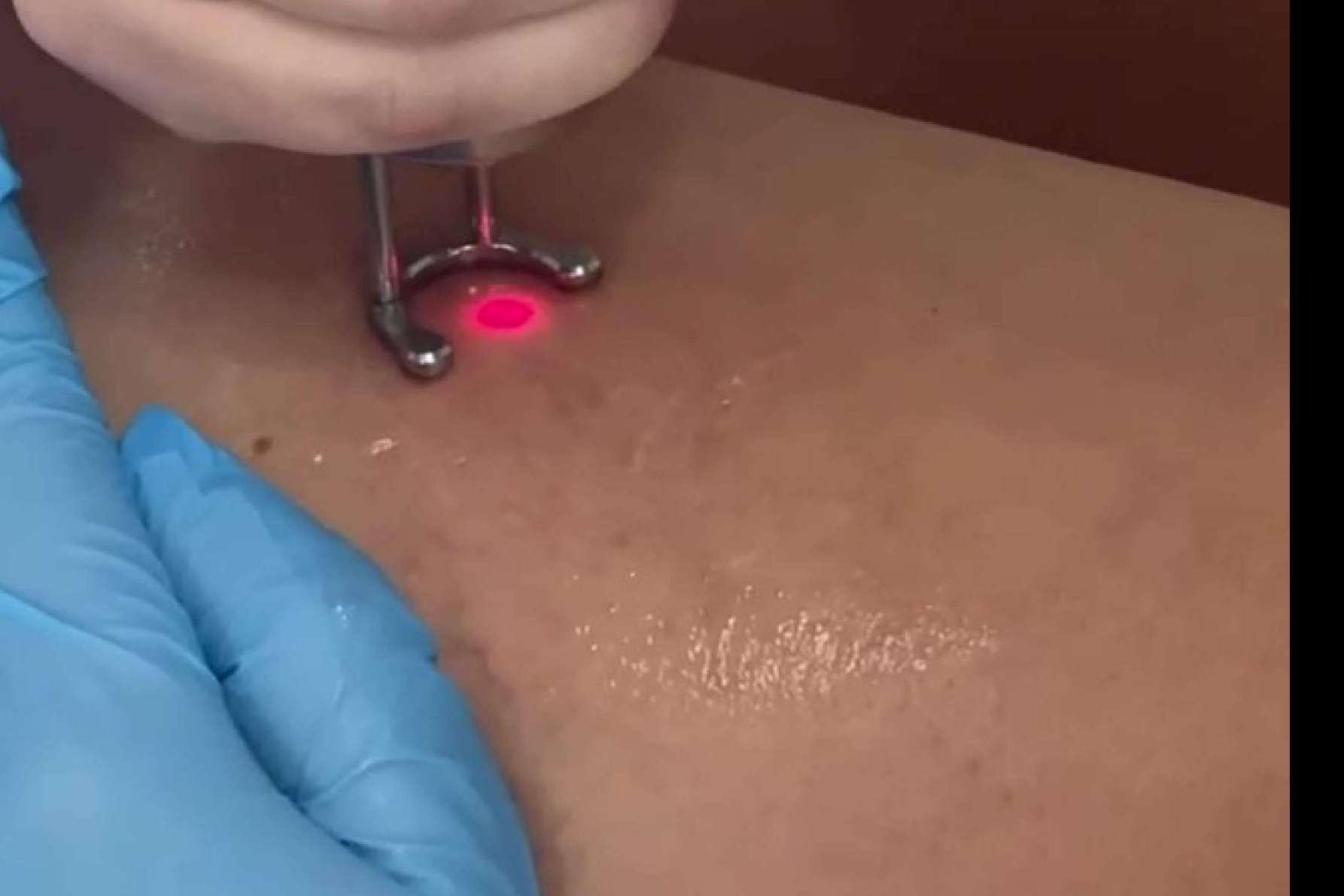 La doctora Yasmin Al Adib elimina las varices en su clínica situada en Sevilla