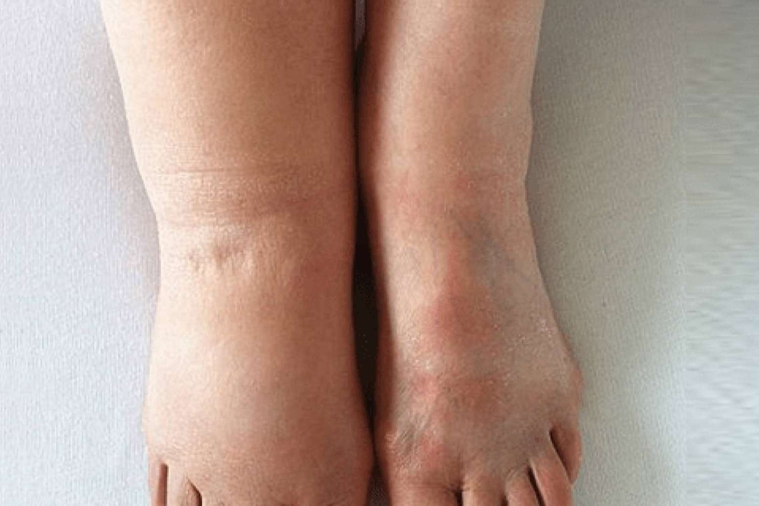 El linfedema ya puede mejorarse. Una tecnología española lo reduce en un 42 % en un mes