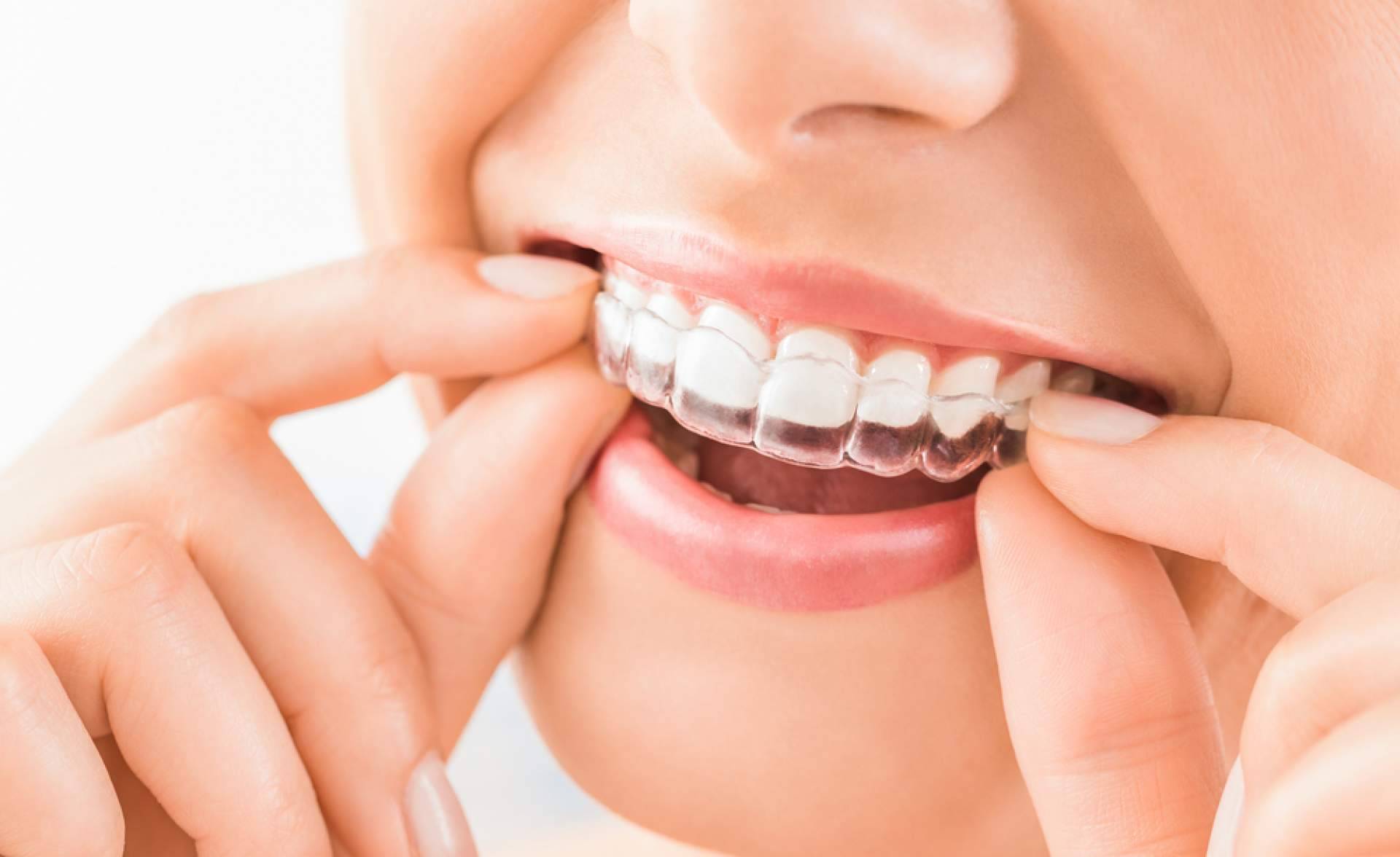 Los beneficios que ofrece la ortodoncia invisible Invisalign, con InterORALIA
