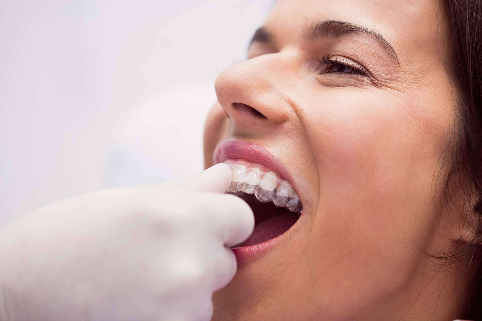 Toda la información acerca de la ortodoncia para adultos, por Clínica Dental Delgado