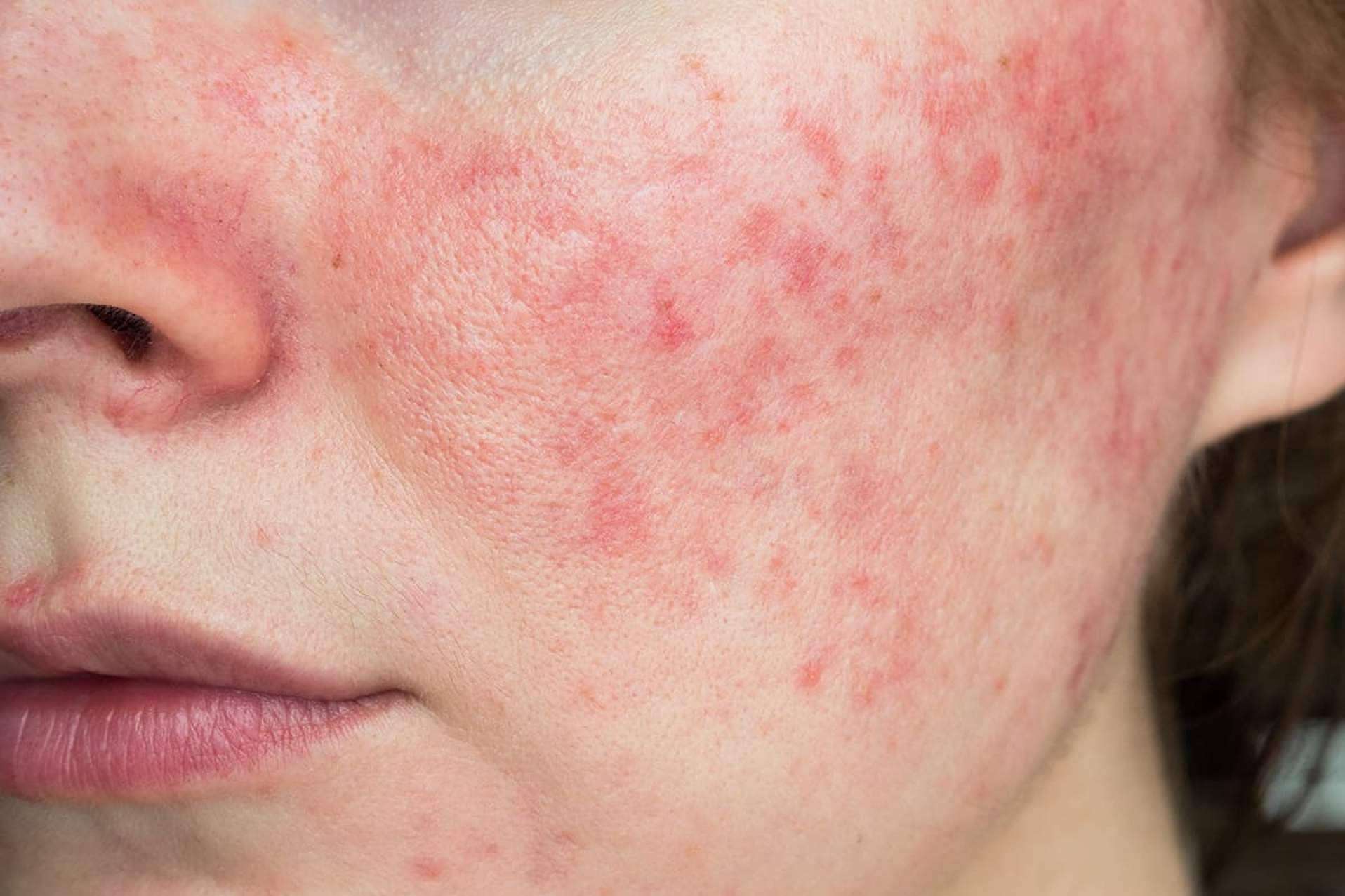 La Clínica Dermatológica De Felipe ofrece tratamientos efectivos para la rosácea