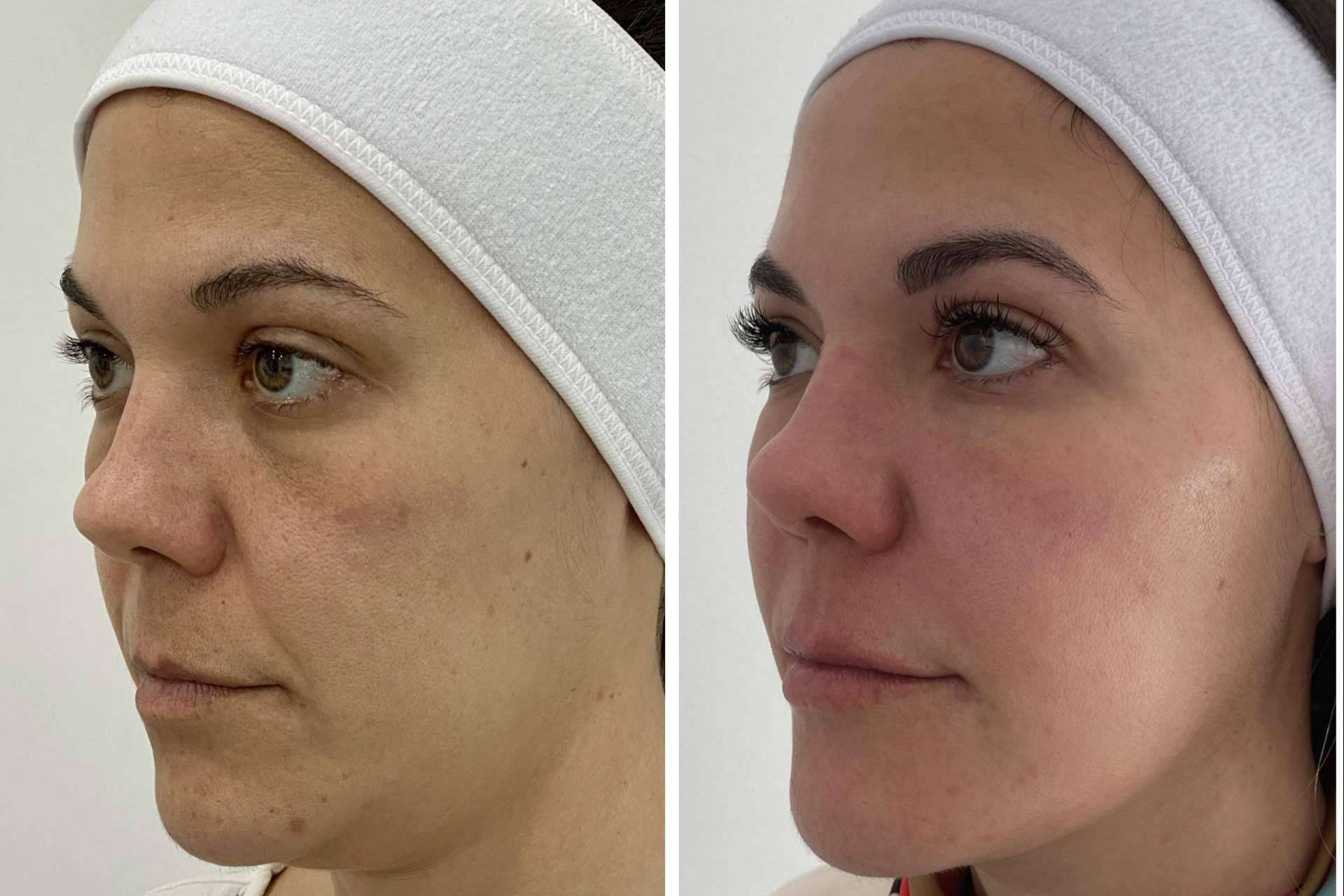 Mejorar la apariencia con los tratamientos faciales de Clínica VISO