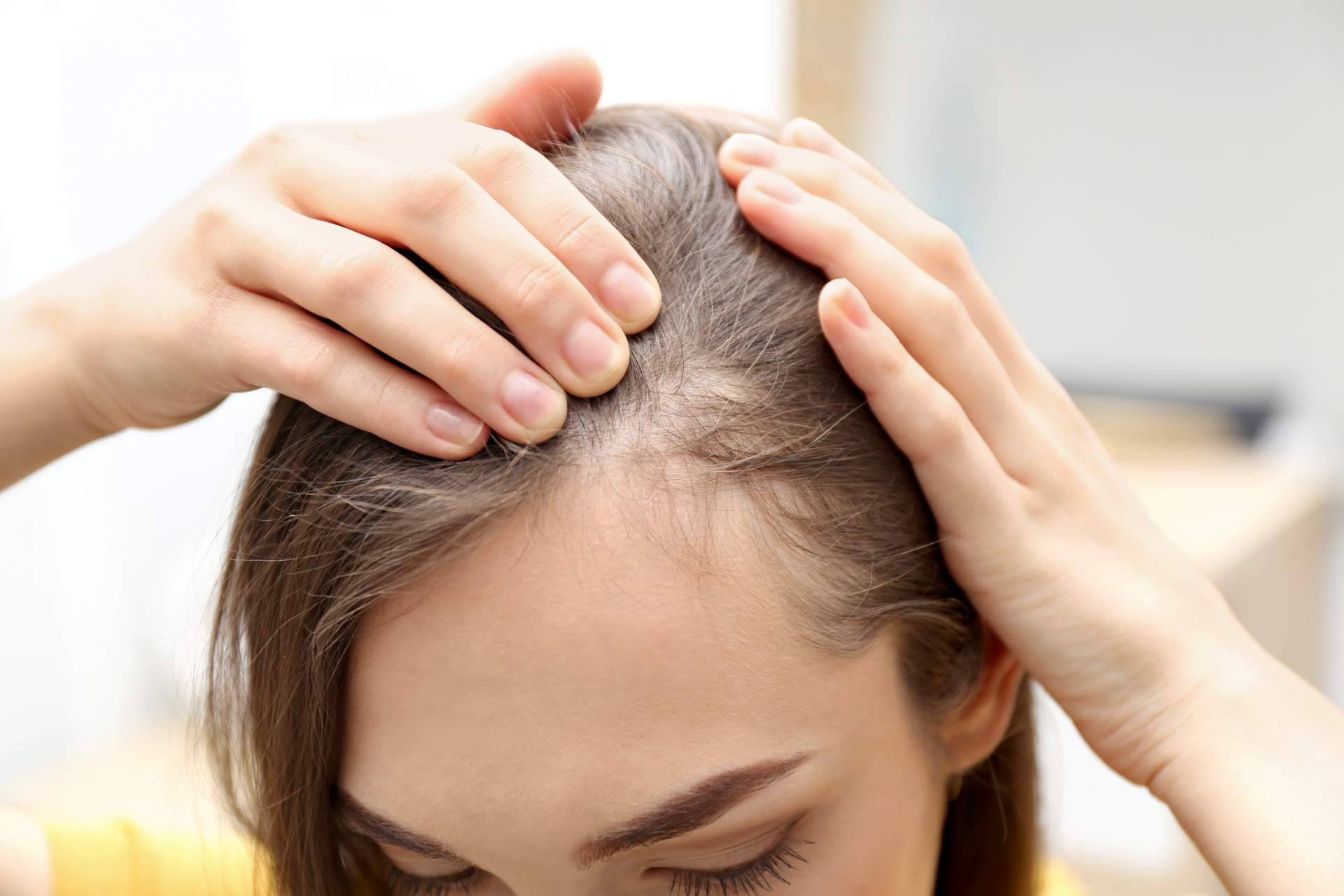 Cómo combatir la alopecia femenina, el método de Capilar Innovation Clinic