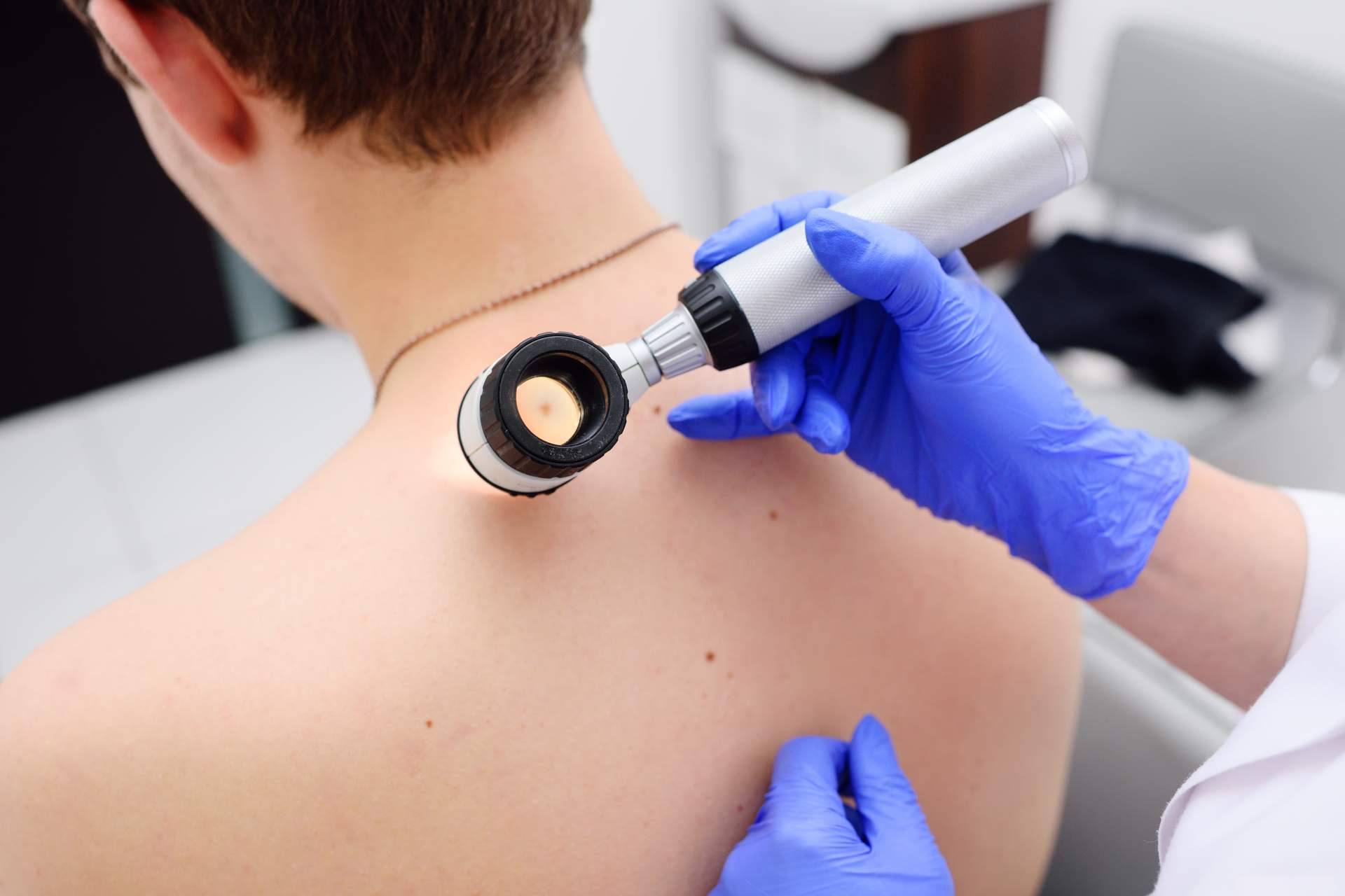Protección ante los melanomas con buenos hábitos al sol como medida de protección
