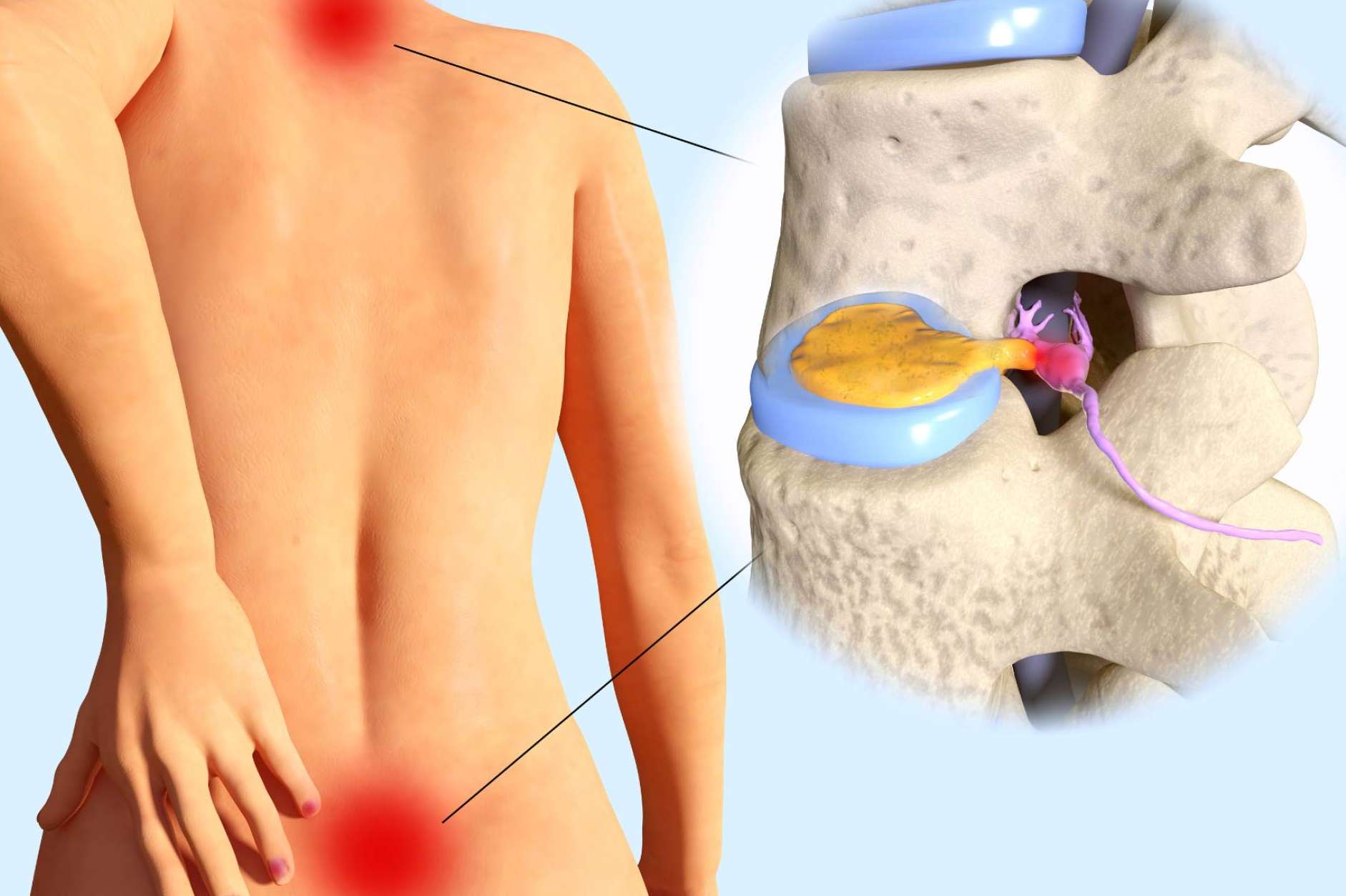 La andulación, un enfoque terapéutico innovador para casos de hernia discal
