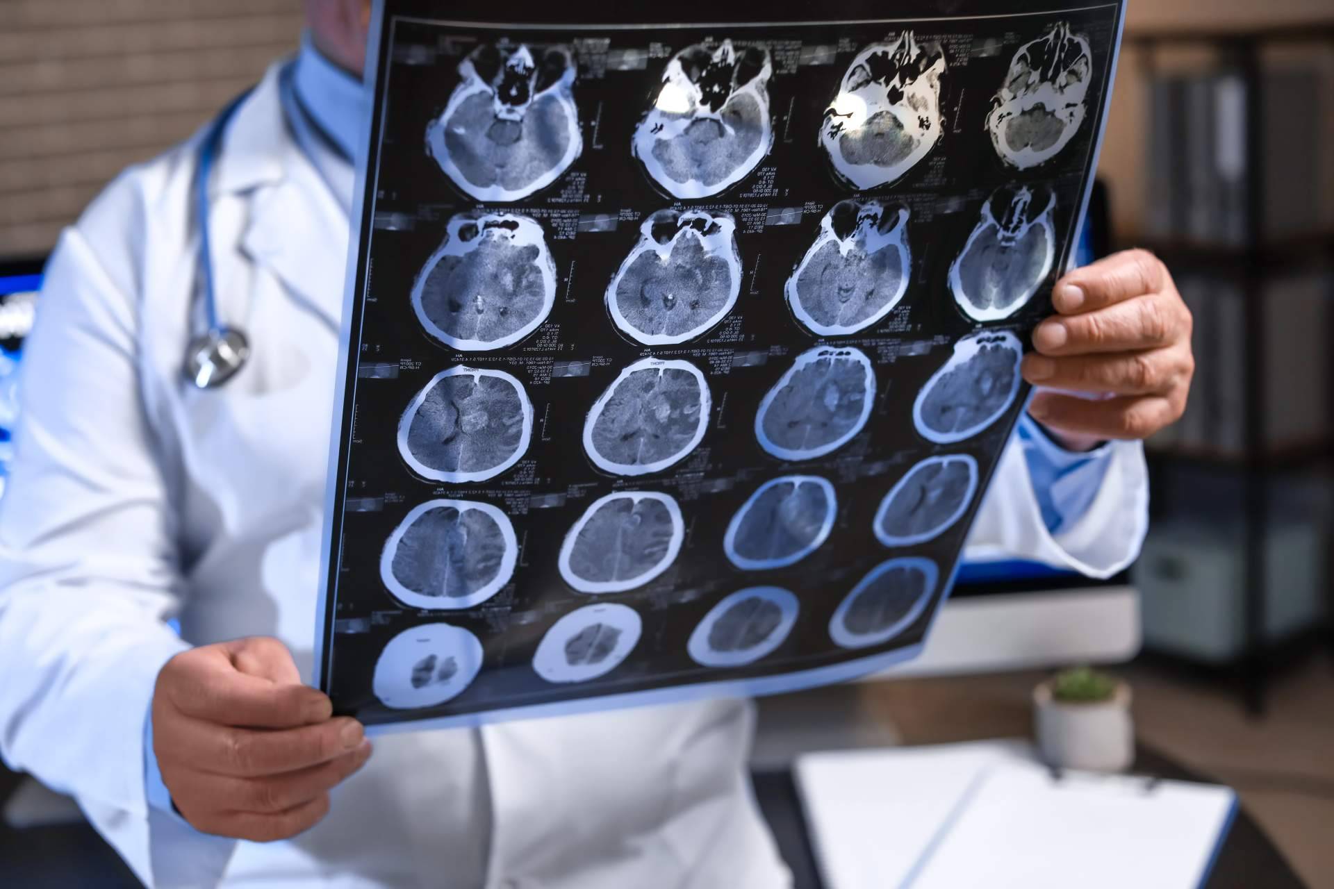 Tratamiento del Alzheimer en fase temprana; innovación en Clínica DKF