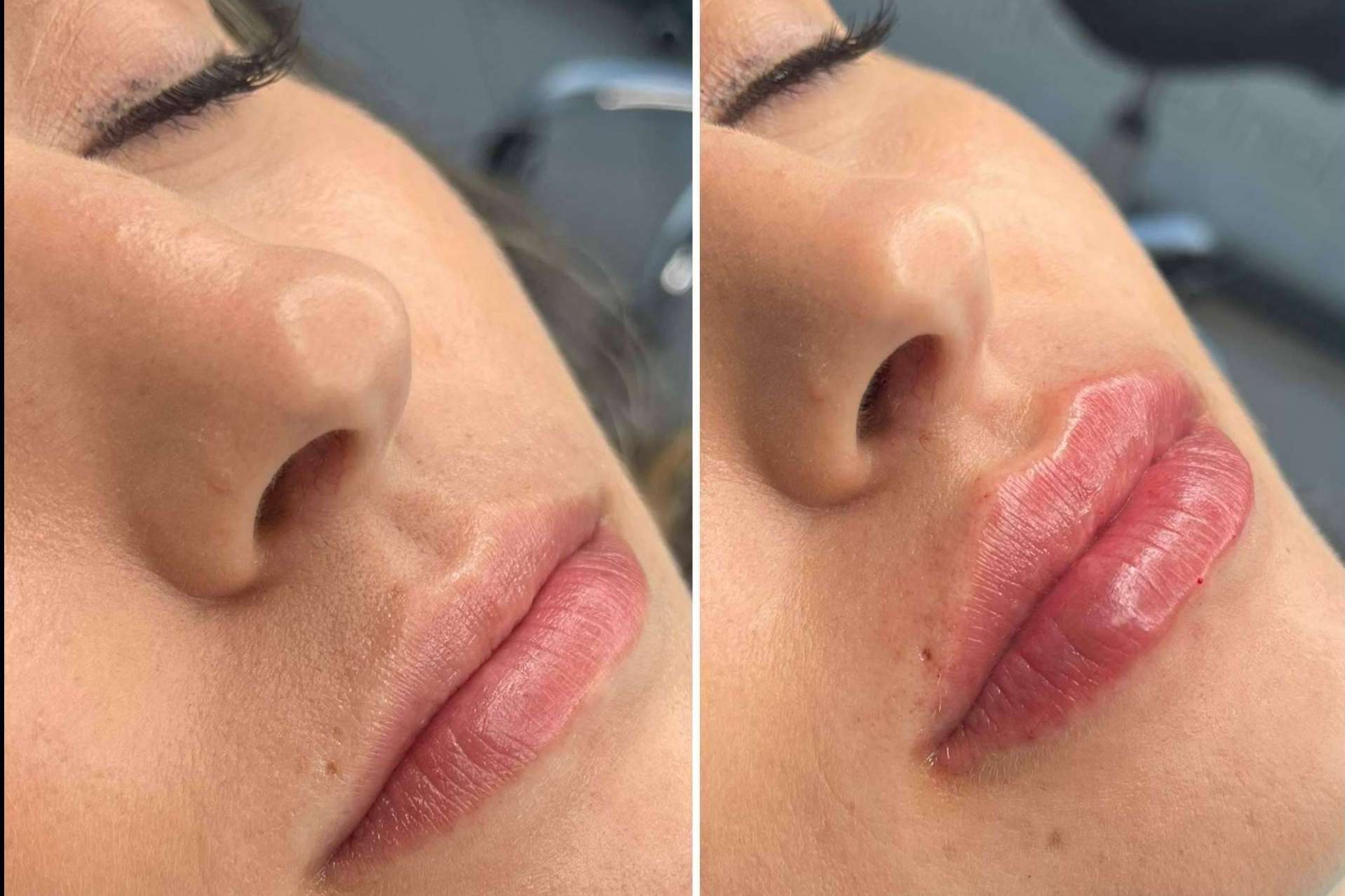 Clínica MG Dental & Estética Facial, especialistas en vial ácido hialuronico labios