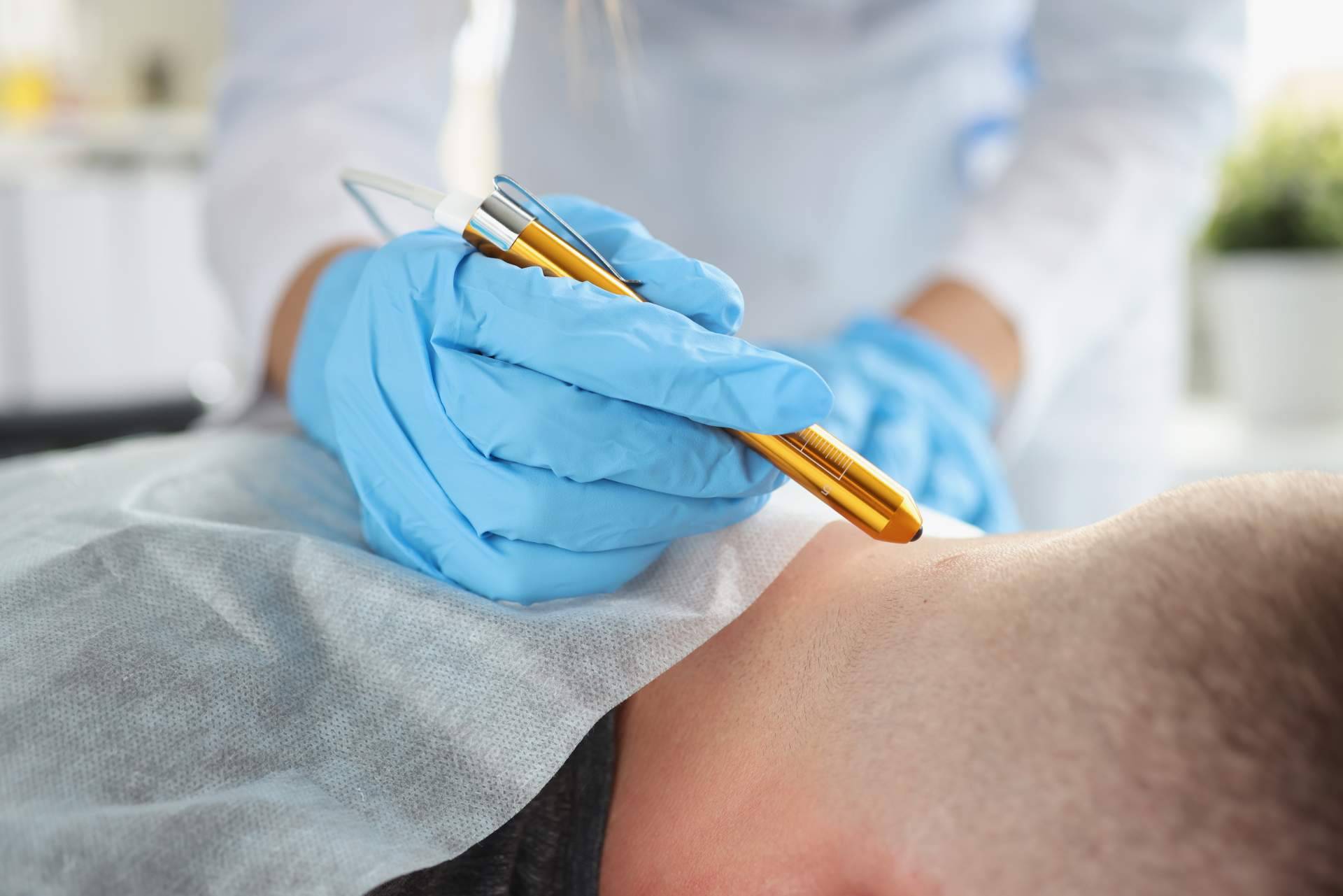 Eliminar lunares y verrugas a través de los tratamientos más innovadores en Centro Estética El Pilar