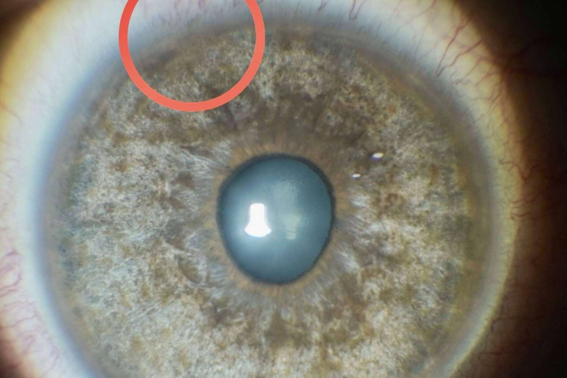 Tratamiento láser de las manchas pigmentarias de la conjuntiva