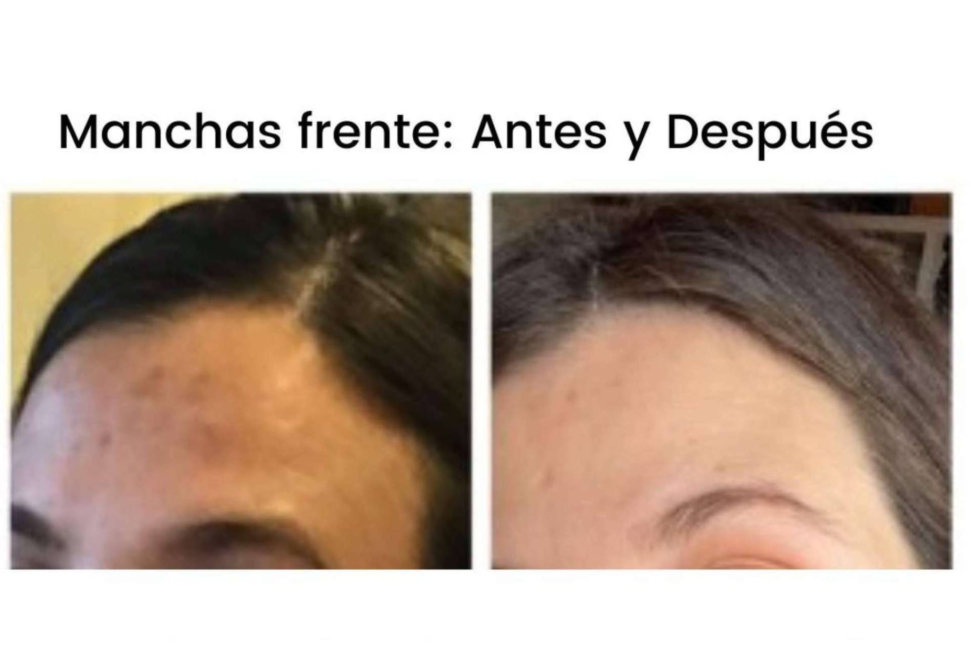 Conseguir el tratamiento skincare con despigmentante facial para después del verano de MiCleo&Co