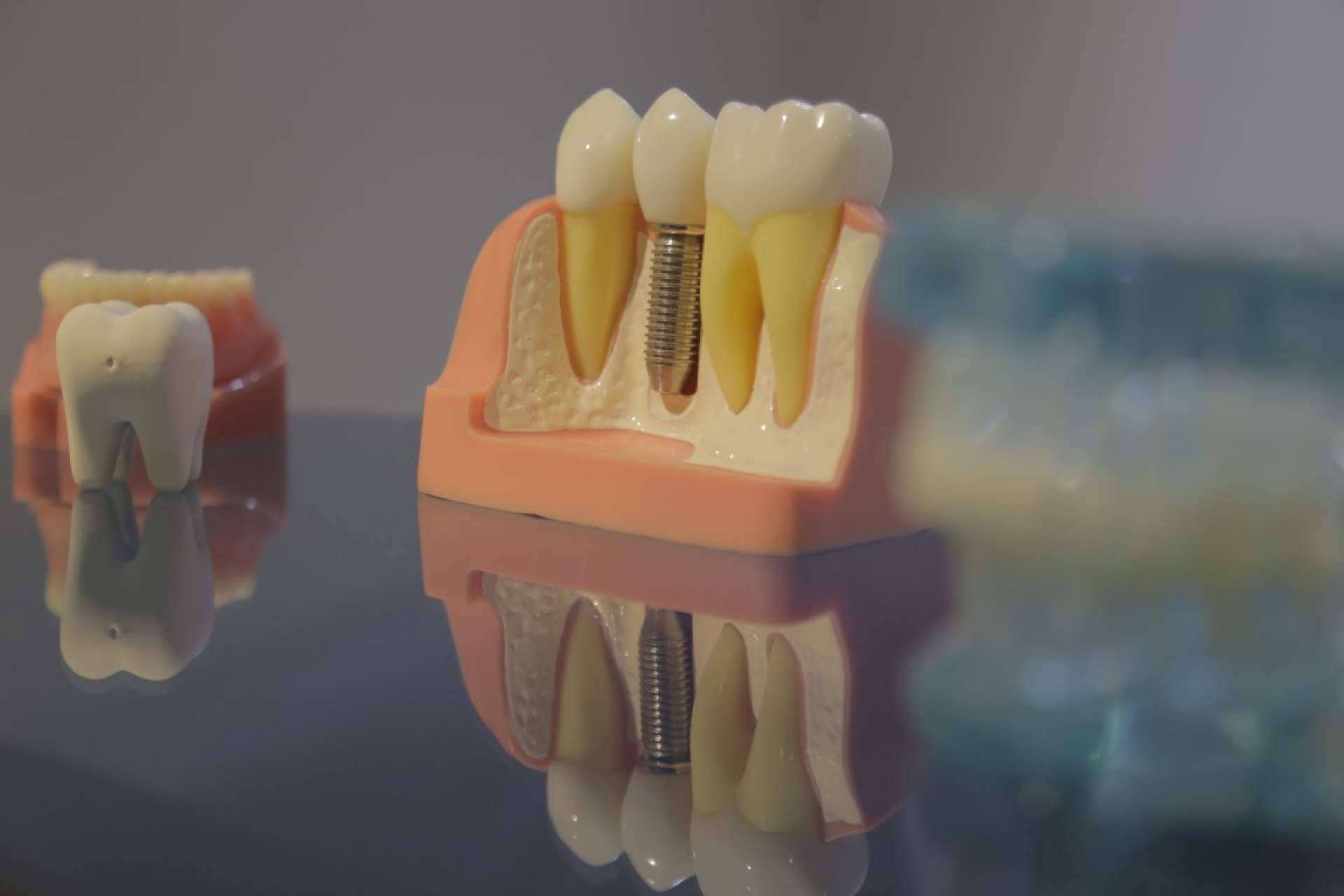 En Mexicali, los implantes dentales son una buena opción y más económica que en Estados Unidos