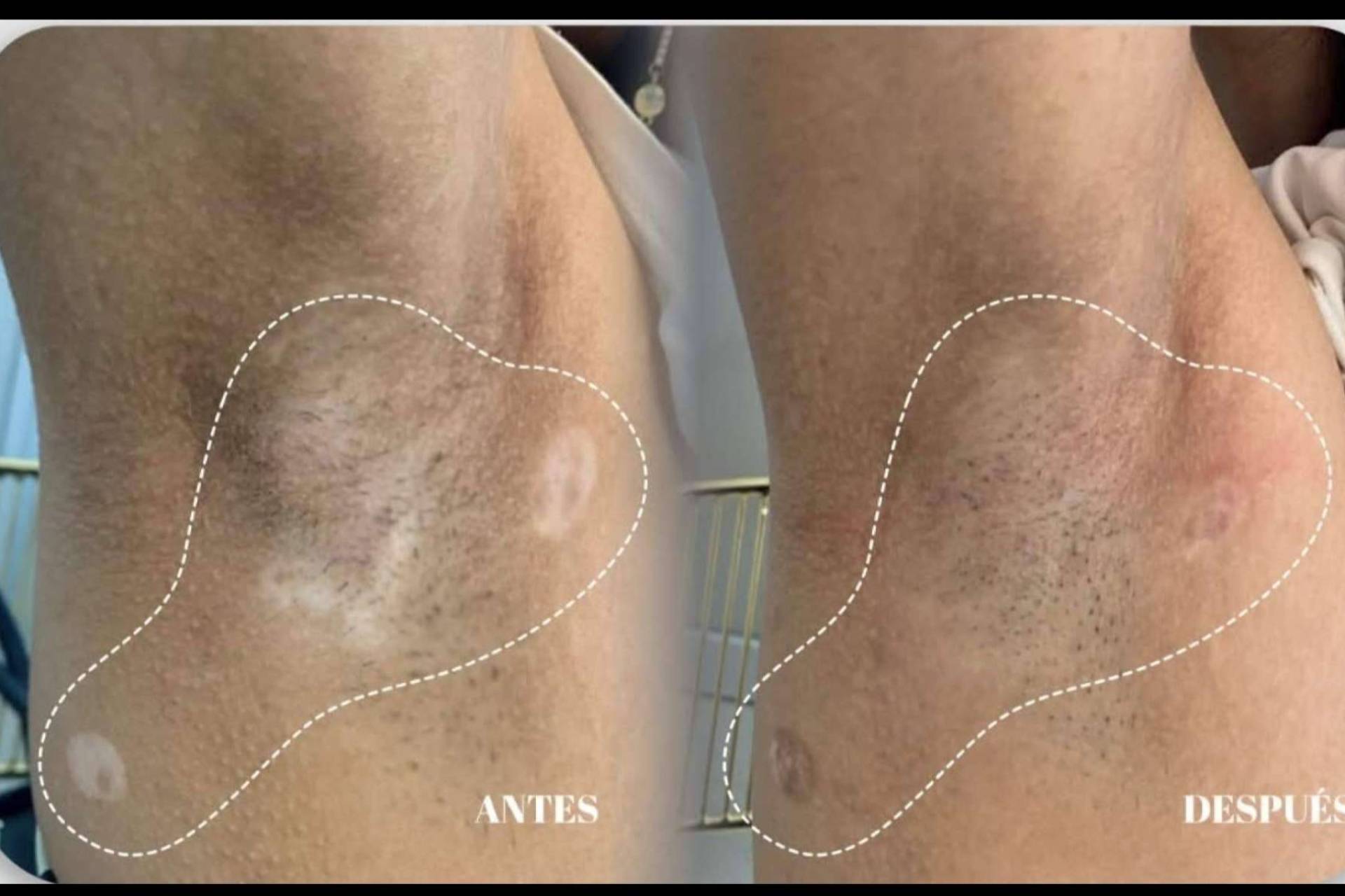 La Dra. Janeth Arévalo implementa terapia combinada para el tratamiento del vitiligo en Clínica God Bless en Loja