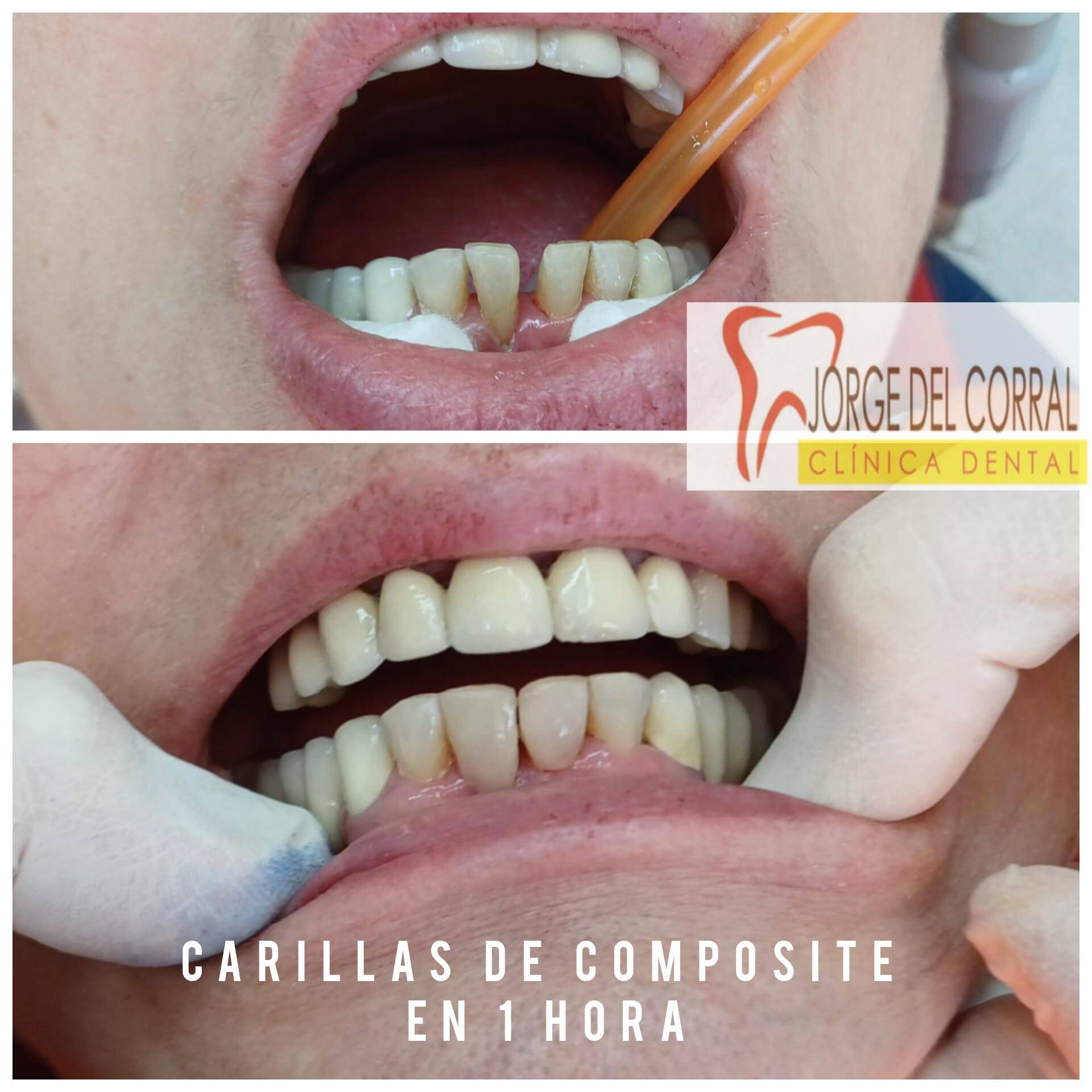 Estética dental de vanguardia con implantes, carillas, prótesis y ortodoncia en la Clínica Dental Jorge del Corral